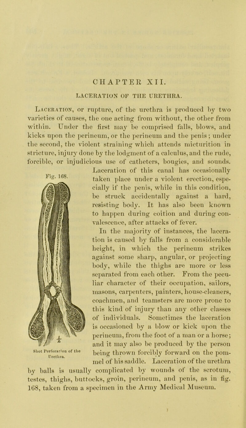 CHAPTER XII. LACERATION OF THE URETHRA. Laceration, or rupture, of the urethra is ]')rocluced hy two varieties of causes, tlie one acting from without, the other from within. Under the tirst may be comprised foils, blows, and kicks upon the perineum, or the perineum and the penis ; under the second, the violent strainins^ which attends micturition in stricture, injury done by the lodgment of a calculus, and the rude, forcible, or injudicious use of catheters, bougies, and sounds. Laceration of this canal has occasionally taken place under a violent erection, espe- cially if the penis, while in this condition, be struck accidentally against a hard, resisting body. It has also been known to happen during coition and during con- valescence, after attacks of fever. In the majority of instances, the lacera- tion is caused by falls from a considerable height, in which the perineum strikes against some shar[), angular, or projecting body, while the thighs are more or less separated from each other. From the pecu- liar character of their occupation, sailors, masons, carpenters, painters, house-cleaners, coachmen, and teamsters are more prone to til is kind of injury than an} other classes oF individuals. Sometimes the laceration is occasioned by a blow or kick upon the perineum, from the foot of a man or a horse; and it may also be produced by the person being thrown forcibly forward on the pom- mel of his saddle. Laceration of the urethra hy balls is usually complicated liy wounds of the scrotum, testes, thighs, buttocks, groin, perineum, and penis, as in lig. 1G8, taken from a specimen in the Army Medical Museum.