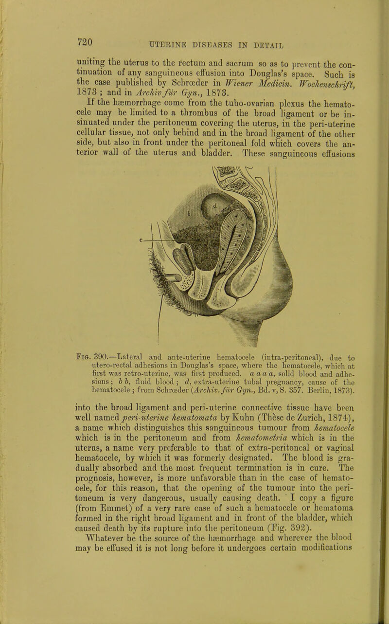 uniting the uterus to the rectum and sacrum so as to prevent the con- tinuation of any sanguineous effusion into Douglas’s space. Such is the case published by Schrceder in Wiener Medicin. Wochensckrift, 1873 ; and in Archiv fur Gyn., 1873. If the haemorrhage come from the tubo-ovarian plexus the hemato- cele may be limited to a thrombus of the broad ligament or be in- sinuated under the peritoneum covering the uterus, in the peri-uterine cellular tissue, not only behind and in the broad ligament of the other side, but also in front under the peritoneal fold which covers the an- terior wall of the uterus and bladder. These sanguineous effusions Fig. 390.—Lateral and ante-uterine hematocele (intra-peritoneal), due to utero-rectal adhesions in Douglas’s space, where the hematocele, which at first was retro-uterine, was first produced, aaaa, solid blood and adhe- sions ; b b, fluid blood; d, extra-uterine tubal pregnancy, cause of the hematocele ; from Schrceder {Archiv. fur Gijn., Bd. v, S. 357. Berlin, 1873). into the broad ligament and peri-uterine connective tissue have been well named peri-uterine hematomata by Kuhn (These de Zurich, 1871), a name which distinguishes this sanguineous tumour from hematocele which is in the peritoneum and from hematometria which is in the uterus, a name very preferable to that of extra-peritoneal or vaginal hematocele, by which it was formerly designated. The blood is gra- dually absorbed and the most frequent termination is in cure. The prognosis, however, is more unfavorable than in the case of hemato- cele, for this reason, that the opening of the tumour into the peri- toneum is very dangerous, usually causing death. I copy a figure (from Emmet) of a very rare case of such a hematocele or hematoma formed in the right broad ligament and in front of the bladder, which caused death by its rupture into the peritoneum (Eig. 392). Whatever be the source of the hmmorrhage and wherever the blood may be effused it is not long before it undergoes certain modifications