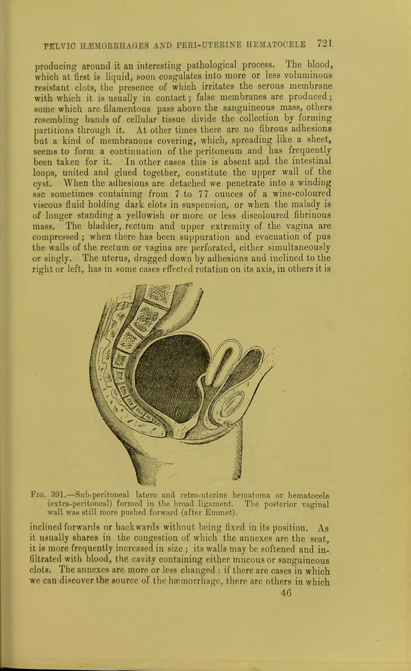 producing around it an interesting pathological process. The blood, which at first is liquid, soon coagulates into more or less voluminous resistant clots, the presence of which irritates the serous membrane with which it is usually in contact; false membranes are produced; some which are filamentous pass above the sanguineous mass, others resembling bands of cellular tissue divide the collection by forming partitions through it. At other times there are no fibrous adhesions but a kind of membranous covering, which, spreading like a sheet, seems to form a continuation of the peritoneum and has frequently been taken for it. In other cases this is absent and the intestinal loops, united and glued together, constitute the upper wall of the cyst. When the adhesions are detached we penetrate into a winding sac sometimes containing from 7 to 77 ounces of a wine-coloured viscous fluid holding dark clots in suspension, or when the malady is of longer standing a yellowish or more or less discoloured fibrinous mass. The bladder, rectum and upper extremity of the vagina are compressed ; when there has been suppuration and evacuation of pus the walls of the rectum or vagina are perforated, either simultaneously or singly. The uterus, dragged down by adhesions and inclined to the right or left, has in some cases effected rotation on its axis, in others it is Fig. 391.—Sub-peritoneal latero and retro-uterine hematoma or hematocele (extra-peritoneal) formed in the broad ligament. The posterior vaginal wall was still more pushed forward (after Emmet). inclined forwards or backwards without being fixed in its position. As it usually shares in the congestion of which the annexes are the seat, it is more frequently increased in size ; its walls may be softened and in- filtrated with blood, the cavity containing either mucous or sanguineous clots. The annexes are more or less changed : if there are cases in which we can discover the source of the haemorrhage, there are others in which 46