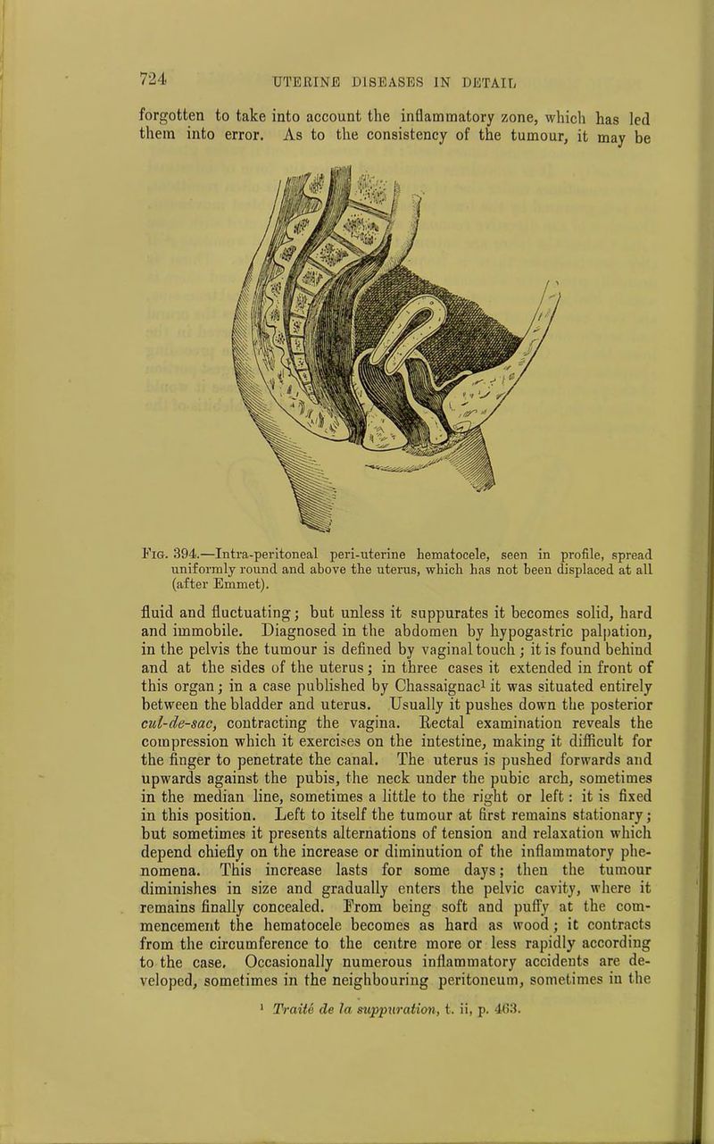 forgotten to take into account the inflammatory zone, which has led them into error. As to the consistency of the tumour, it may be Fig. 394.—Tntra-peritoneal peri-uterine hematocele, seen in profile, spread uniformly round and above the uterus, which has not been displaced at all (after Emmet). fluid and fluctuating; but unless it suppurates it becomes solid, hard and immobile. Diagnosed in the abdomen by hypogastric palpation, in the pelvis the tumour is defined by vaginal touch; it is found behind and at the sides of the uterus; in three cases it extended in front of this organ; in a case published by Chassaignac1 it was situated entirely between the bladder and uterus. Usually it pushes down the posterior cul-de-sac, contracting the vagina. Eectal examination reveals the compression which it exercises on the intestine, making it difficult for the finger to penetrate the canal. The uterus is pushed forwards and upwards against the pubis, the neck under the pubic arch, sometimes in the median line, sometimes a little to the right or left: it is fixed in this position. Left to itself the tumour at first remains stationary; but sometimes it presents alternations of tension and relaxation which depend chiefly on the increase or diminution of the inflammatory phe- nomena. This increase lasts for some days; then the tumour diminishes in size and gradually enters the pelvic cavity, where it remains finally concealed. Trom being soft and puffy at the com- mencement the hematocele becomes as hard as wood; it contracts from the circumference to the centre more or less rapidly according to the case. Occasionally numerous inflammatory accidents are de- veloped, sometimes in the neighbouring peritoneum, sometimes in the 1 Traite cle la suppuration, t. ii, p. 463.