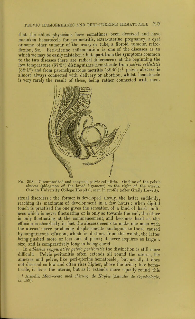 that the ablest physicians have sometimes been deceived and have mistaken hematocele for perimetritis, extra-uterine pregnancy, a cyst or some other tumour of the ovary or tube, a fibroid tumour, retro- flexion, &c. Peri-uterine inflammation is one of the diseases as to which we may be easily mistaken : but apart from the symptoms common to the two diseases there are radical differences: at the beginning the low temperature (37’5°) distinguishes hematocele from pelvic cellulitis (38’1°) and from parenchymatous metritis (39'50^) pelvic abscess is almost always connected with delivery or abortion, whilst hematocele is very rarely the result of these, being rather connected with men- Fig. 398.—Circumscribed and encysted pelvic cellulitis. Outline of the pelvic abscess (phlegmon of the broad ligament) to the right of the uterus. Case in University College Hospital, seen in profile (after Graily Hewitt). strual disorders; the former is developed slowly, the latter suddenly, reaching its maximum of development in a few hours; when digital touch is practised the one gives the sensation of a kind of hard puffi- ness which is never fluctuating or is only so towards the end, the other is only fluctuating at the commencement, and becomes hard as the effusion is absorbed; in fact the abscess seems to make one mass with the uterus, never producing displacements analogous to those caused by sanguineous effusion, which is distinct from the womb, the latter being pushed more or less out of place; it never acquires so large a size, and is comparatively long in being cured. In adhesive suppurative pelvic peritonitis the distinction is still more difficult. Pelvic peritonitis often extends all round the uterus, the annexes and pelvis, like peri-uterine hematocele; but usually it does not descend so low and often rises higher, above the brim; like hema- tocele, it fixes the uterus, but as it extends more equally round this 1 Avmelli, Movimento med. chirurg. dc Naples (Anncilcs dc Gynecologic, ix, 159).