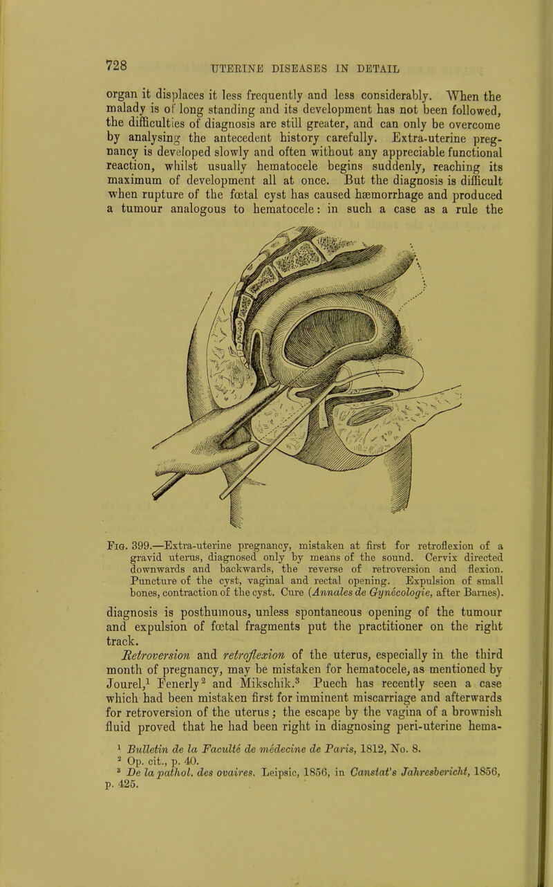organ it displaces it less frequently and less considerably. When the malady is of long standing and its development has not been followed, the difficulties of diagnosis are still greater, and can only be overcome by analysing the antecedent history carefully. Extra-uterine preg- nancy is developed slowly and often without any appreciable functional reaction, whilst usually hematocele begins suddenly, reaching its maximum of development all at once. But the diagnosis is difficult when rupture of the foetal cyst has caused htEmorrhage and produced a tumour analogous to hematocele: in such a case as a rule the Fig. 399.—Extra-uterine pregnancy, mistaken at first for retroflexion of a gravid uterus, diagnosed only by means of the sound. Cervix directed downwards and backwards, the reverse of retroversion and flexion. Puncture of the cyst, vaginal and rectal opening. Expulsion of small bones, contraction of the cyst. Cure (Annales de Gynecologie, after Barnes). diagnosis is posthumous, unless spontaneous opening of the tumour and expulsion of foetal fragments put the practitioner on the right track. Retroversion and retroflexion of the uterus, especially in the third month of pregnancy, may be mistaken for hematocele, as mentioned by Jourel,1 Eenerly2 3 * and Mikschik.8 Puech has recently seen a case which had been mistaken first for imminent miscarriage and afterwards for retroversion of the uterus; the escape by the vagina of a brownish fluid proved that he had been right in diagnosing peri-uterine hema- 1 Bulletin de la Faculte de medecine de Paris, 1812, No. 8. 2 Op. cit., p. 40. 3 De lapathol. des ovaires. Leipsic, 1856, in Constat's Jahrcsbericht, 1856, p. 425.