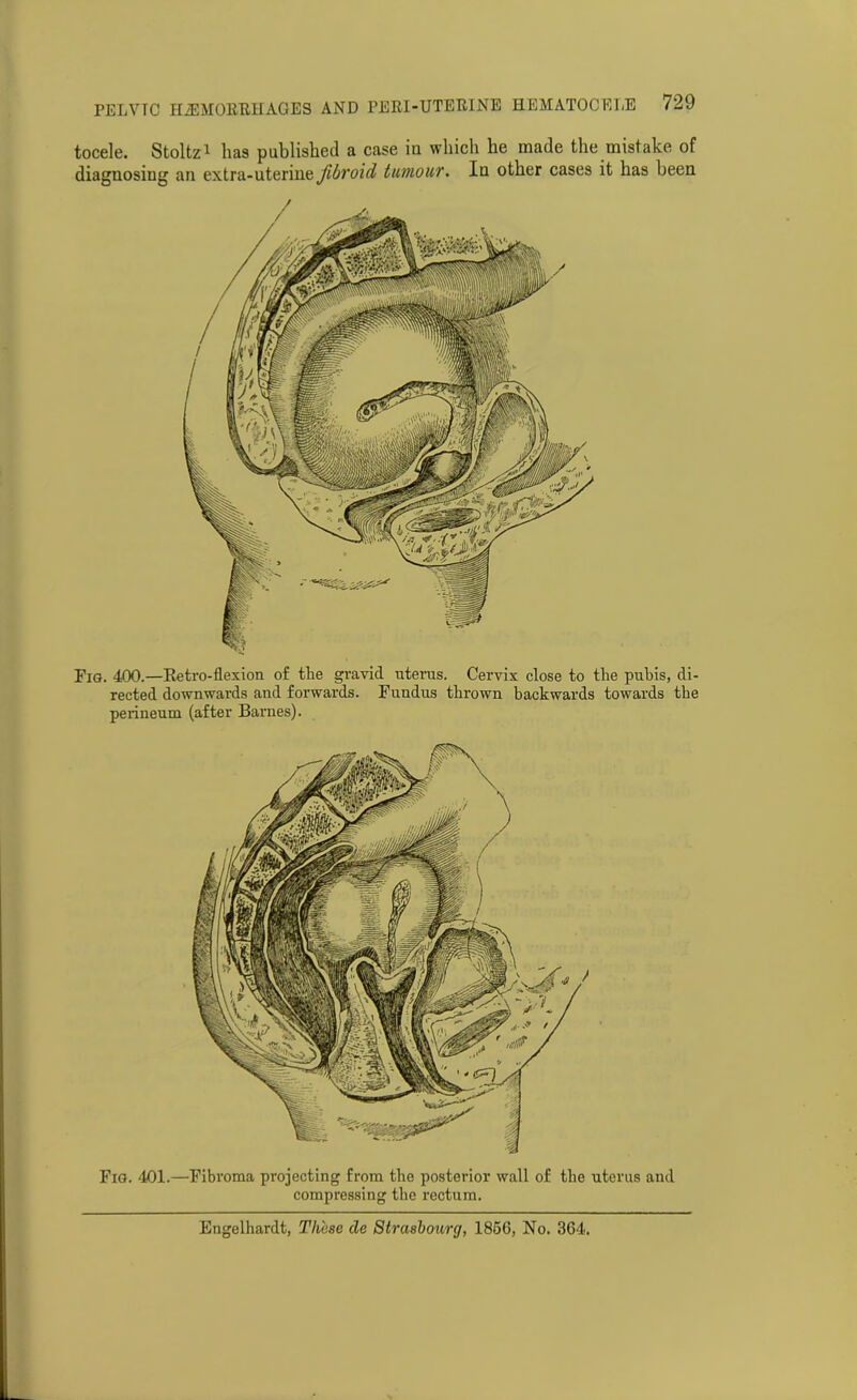 Fig. 400.—Retro-flexion of the gravid uterus. Cervix close to the pubis, di- rected downwards and forwards. Fundus thrown backwards towards the perineum (after Barnes). PELVTC HAEMORRHAGES AND PERI-UTERINE HEMATOCELE 729 tocele. Stoltz1 lias published a case iu which he made the mistake of diagnosing an extra-uterine fibroid tumour. In other cases it has been Fig. 401.—Fibroma projecting from the posterior wall of the uterus and compressing the rectum. Engelhardt, These de Strasbourg, 1856, No. 364.