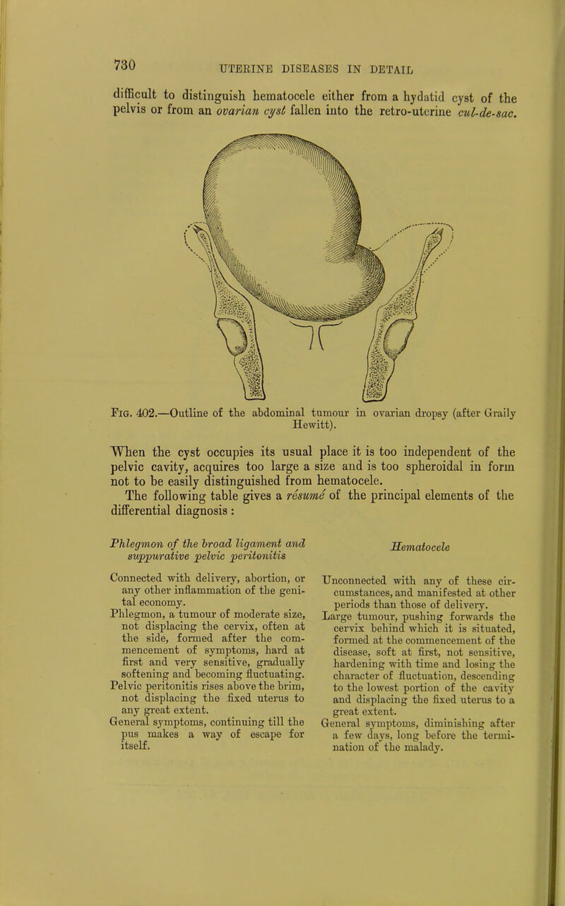difficult to distinguish hematocele either from a hydatid cyst of the pelvis or from an ovarian cyst fallen into the retro-uterine cul-de-sac. Fig. 402.—Outline of the abdominal tumour in ovarian dropsy (after Graily Hewitt). When the cyst occupies its usual place it is too independent of the pelvic cavity, acquires too large a size and is too spheroidal in form not to be easily distinguished from hematocele. The following table gives a resume of the principal elements of the differential diagnosis : Phlegmon of the broad ligament and suppurative pelvic peritonitis Connected with delivery, abortion, or any other inflammation of the geni- tal economy. Phlegmon, a tumour of moderate size, not displacing the cervix, often at the side, formed after the com- mencement of symptoms, hard at first and very sensitive, gradually softening and becoming fluctuating. Pelvic peritonitis rises above the brim, not displacing the fixed uterus to any great extent. General symptoms, continuing till the pus makes a way of escape for itself. Hematocele Unconnected with any of these cir- cumstances, and manifested at other periods than those of delivery. Large tumour, pushing forwards the cervix behind which it is situated, formed at the commencement of the disease, soft at first, not sensitive, hardening with time and losing the character of fluctuation, descending to the lowest portion of the cavity and displacing the fixed uterus to a great extent. General symptoms, diminishing after a few days, long before the termi- nation of the malady.
