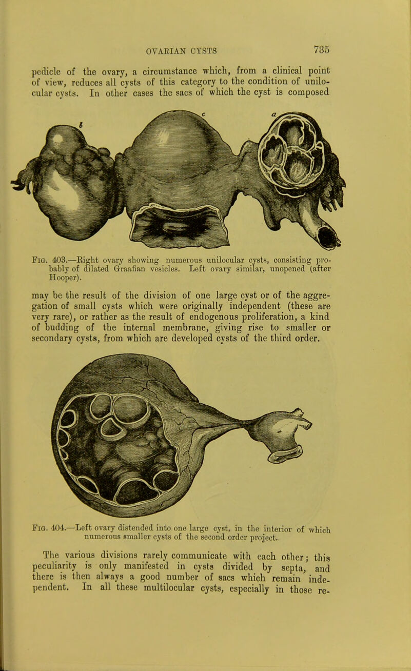 pedicle of the ovary, a circumstance which, from a clinical point of view, reduces all cysts of this category to the condition of unilo- cular cysts. In other cases the sacs of which the cyst is composed Fig. 403.—Right ovary showing numerous unilocular cysts, consisting pro- bably of dilated Graafian vesicles. Left ovary similar, unopened (after Hooper). may be the result of the division of one large cyst or of the aggre- gation of small cysts which were originally independent (these are very rare), or rather as the result of endogenous proliferation, a kind of budding of the internal membrane, giving rise to smaller or secondary cysts, from which are developed cysts of the third order. Fig. 404.—Left ovary distended into one large cyst, in the interior of which numerous smaller cysts of the second order project. The various divisions rarely communicate with each other; this peculiarity is only manifested in cysts divided by septa, and there is then always a good number of sacs which remain inde- pendent. In all these multilocular cysts, especially in those re-