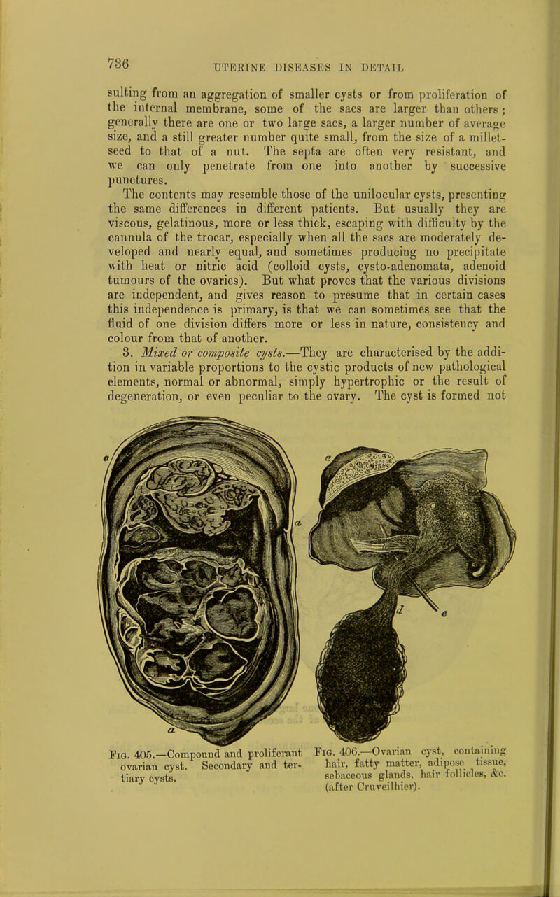 suiting from an aggregation of smaller cysts or from proliferation of the internal membrane, some of the sacs are larger than others; generally there are one or two large sacs, a larger number of average size, and a still greater number quite small, from the size of a millet- seed to that of a nut. The septa are often very resistant, and we can only penetrate from one into another by successive punctures. The contents may resemble those of the unilocular cysts, presenting the same differences in different patients. But usually they are viscous, gelatinous, more or less thick, escaping with difficulty by the cannula of the trocar, especially when all the sacs are moderately de- veloped and nearly equal, and sometimes producing no precipitate with heat or nitric acid (colloid cysts, cysto-adenomata, adenoid tumours of the ovaries). But what proves that the various divisions are independent, and gives reason to presume that in certain cases this independence is primary, is that we can sometimes see that the fluid of one division differs more or less in nature, consistency and colour from that of another. 3. Mixed or composite cysts.—They are characterised by the addi- tion in variable proportions to the cystic products of new pathological elements, normal or abnormal, simply hypertrophic or the result of degeneration, or even peculiar to the ovary. The cyst is formed not Fig. 405.—Compound and proliferant ovarian cyst. Secondary and ter- tiary cysts. Fig. 406.—Ovarian cyst, containing hair, fatty matter, adipose tissue, sebaceous glands, hair follicles, &c. (after Cruveilhier).