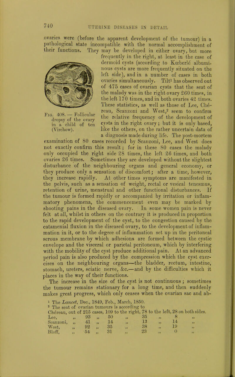 ovaries were (before the apparent development of the tumour) in a pathological state incompatible with the normal accomplishment of their functions. They may be developed in either ovary, but more frequently in the right, at least in the case of dermoid cysts (according to Kceberlt; albumi- nous cysts are more frequently situated on the left side), and in a number of cases in both ovaries simultaneously. Tilt1 has observed out of 475 cases of ovarian cysts that the seat of the malady was in the right ovary 260 times, in the left 170 times, and in both ovaries 42 times. These statistics, as well as those of Lee, Ch4- reau, Scanzoni and West,2 seem to confirm the relative frequency of the development of cysts in the right ovary ; but it is only based, like the others, on the rather uncertain data of a diagnosis made during life. The post-mortem examination of 80 cases recorded by Scanzoni, Lee, and West does not exactly confirm this result; for in these 80 cases the malady only occupied the right side 28 times, the left 26 times, and both ovaries 26 times. Sometimes they are developed without the slightest disturbance of the neighbouring organs and general economy, or they produce only a sensation of discomfort; after a time, however, they increase rapidly. At other times symptoms are manifested in the pelvis, such as a sensation of weight, rectal or vesical tenesmus, retention of urine, menstrual and other functional disturbances. If the tumour is formed rapidly or accompanied by irritation or inflam- matory phenomena, the commencement even may be marked by shooting pains in the diseased ovary. In some women pain is never felt at all, whilst in others on the contrary it is produced in proportion to the rapid development of the cyst, to the congestion caused by the catamenial fluxion in the diseased ovary, to the development of inflam- mation in it, or to the degree of inflammation set up in the peritoneal serous membrane by which adhesions are formed between the cystic envelope and the visceral or parietal peritoneum, which by interfering with the mobility of the cyst produce additional pain. At an advanced period pain is also produced by the compression which the cyst exer- cises on the neighbouring organs—the bladder, rectum, intestine, stomach, ureters, sciatic nerve, &c.— and by the difficulties which it places in the way of their functions. The increase in the size of the cyst is not continuous ; sometimes the tumour remains stationary for a long time, and then suddenly makes great progress, which only ceases when the ovarian sac and ab- Fig. 408. — Follicular dropsy of the ovary in a child of ten (Virchow). 1 The Lancet, Dec., 1849, Feb., March, 1850. 3 The seat of ovarian tumours is according to Chdreau, out of 215 cases, 109 to the right, 78 to the left, 28 on both sides. Lee, „ 93 „ 50 „ 35 „ 8 Scanzoni, „ 41 „ 14 „ 13 ,, 14 „ West, „ 92 „ 35 „ 38 „ 19 Bloff, „ 54 „ 31 „ 23 „ 0