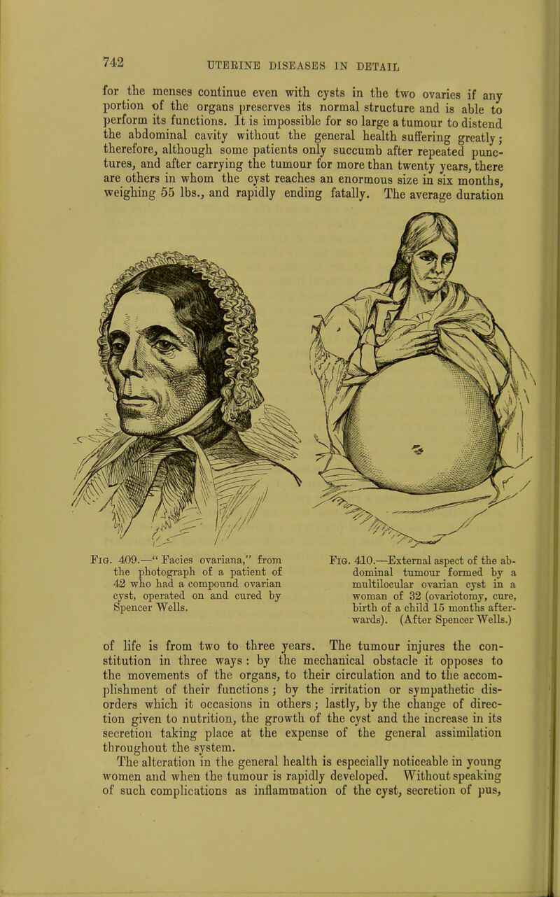 for the menses continue even with cysts in the two ovaries if any portion of the organs preserves its normal structure and is able to perform its functions. It is impossible for so large a tumour to distend the abdominal cavity without the general health suffering greatly; therefore, although some patients only succumb after repeated punc- tures, and after carrying the tumour for more than twenty years, there are others in whom the cyst reaches an enormous size in six months, weighing 55 lbs., and rapidly ending fatally. The average duration the photograph of a patient of 42 who had a compound ovarian cyst, operated on and cured by Spencer Wells. Fig. 410.—External aspect of the ab- dominal tumour formed by a multilocular ovarian cyst in a woman of 32 (ovariotomy, cure, birth of a child 15 months after- wards). (After Spencer Wells.) of life is from two to three years. The tumour injures the con- stitution in three ways : by the mechanical obstacle it opposes to the movements of the organs, to their circulation and to the accom- plishment of their functions; by the irritation or sympathetic dis- orders which it occasions in others; lastly, by the change of direc- tion given to nutrition, the growth of the cyst and the increase in its secretion taking place at the expense of the general assimilation throughout the system. The alteration in the general health is especially noticeable in young women and when the tumour is rapidly developed. Without speaking of such complications as inflammation of the cyst, secretion of pus,
