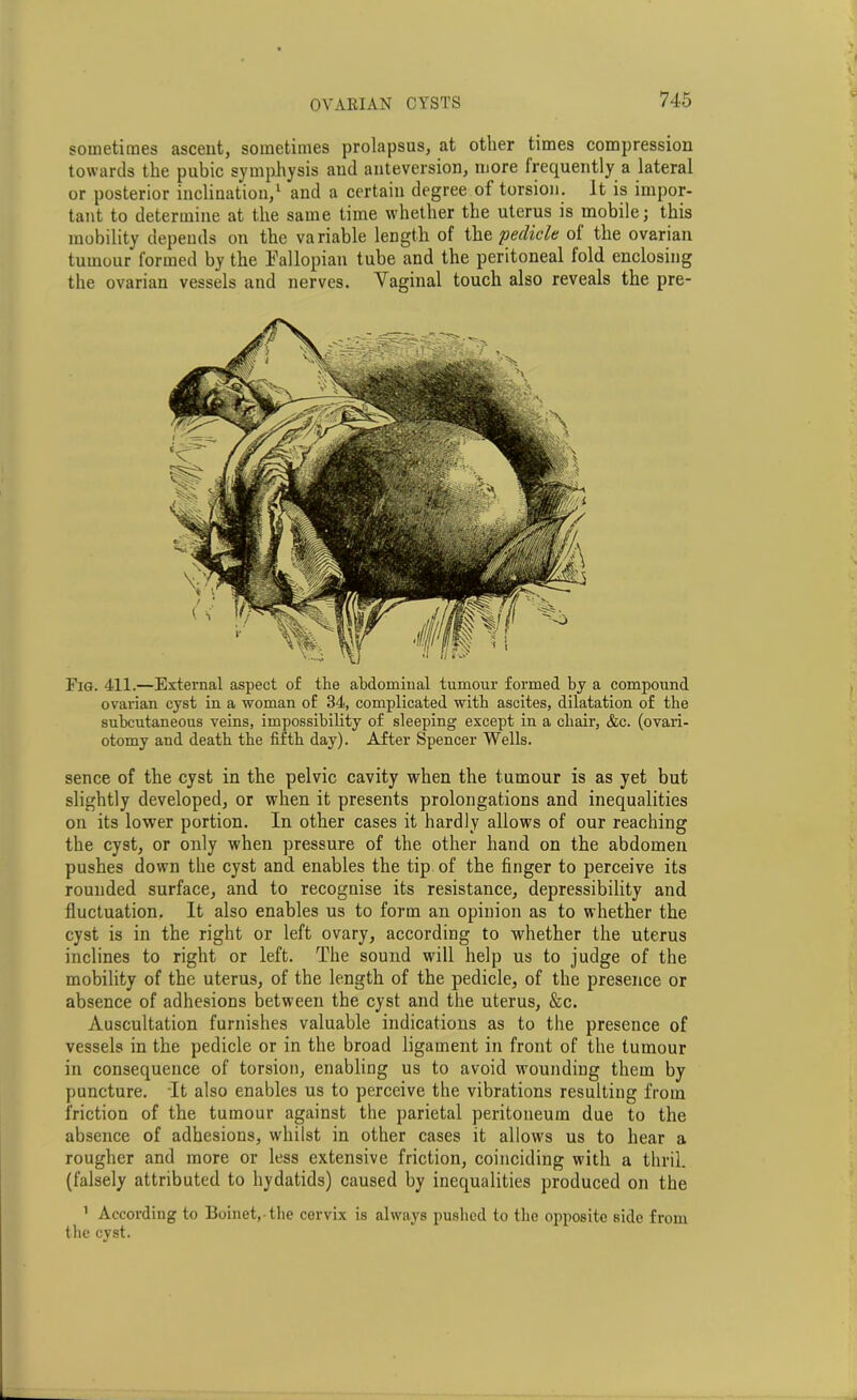 sometimes ascent, sometimes prolapsus, at other times compression towards the pubic symphysis and anteversion, more frequently a lateral or posterior inclination,1 and a certain degree of torsion. It is impor- tant to determine at the same time whether the uterus is mobile; this mobility depends on the variable length of the pedicle ol the ovarian tumour formed by the Fallopian tube and the peritoneal fold enclosing the ovarian vessels and nerves. Vaginal touch also reveals the pre- Fig. 411.—External aspect of the abdominal tumour formed by a compound ovarian cyst in a woman of 34, complicated with ascites, dilatation of the subcutaneous veins, impossibility of sleeping except in a chair, &c. (ovari- otomy and death the fifth day). After Spencer Wells. sence of the cyst in the pelvic cavity when the tumour is as yet but slightly developed, or when it presents prolongations and inequalities on its lower portion. In other cases it hardly allows of our reaching the cyst, or only when pressure of the other hand on the abdomen pushes down the cyst and enables the tip of the finger to perceive its rounded surface, and to recognise its resistance, depressibility and fluctuation. It also enables us to form an opinion as to whether the cyst is in the right or left ovary, according to whether the uterus inclines to right or left. The sound will help us to judge of the mobility of the uterus, of the length of the pedicle, of the presence or absence of adhesions between the cyst and the uterus, &c. Auscultation furnishes valuable indications as to the presence of vessels in the pedicle or in the broad ligament in front of the tumour in consequence of torsion, enabling us to avoid wounding them by puncture. It also enables us to perceive the vibrations resulting from friction of the tumour against the parietal peritoneum due to the absence of adhesions, whilst in other cases it allows us to hear a rougher and more or less extensive friction, coinciding with a thril. (falsely attributed to hydatids) caused by inequalities produced on the ’ According to Boinet,-the cervix is always pushed to the opposite side from the cyst.