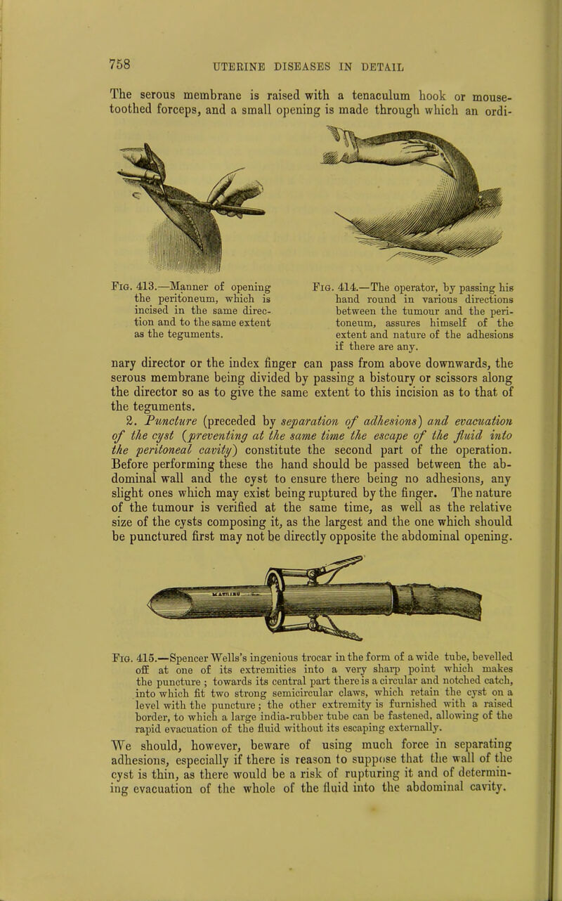 The serous membrane is raised with a tenaculum hook or mouse- toothed forceps, and a small opening is made through which an ordi- Fig. 413.—Manner of opening the peritoneum, which is incised in the same direc- tion and to the same extent as the teguments. Fig. 414.—The operator, by passing his hand round in various directions between the tumour and the peri- toneum, assures himself of the extent and nature of the adhesions if there are any. nary director or the index finger can pass from above downwards, the serous membrane being divided by passing a bistoury or scissors along the director so as to give the same extent to this incision as to that of the teguments. 2. Puncture (preceded by separation of adhesions) and evacuation of the cyst (preventing at the same time the escape of the fluid into the peritoneal cavity') constitute the second part of the operation. Before performing these the hand should be passed between the ab- dominal wall and the cyst to ensure there being no adhesions, any slight ones which may exist being ruptured by the finger. The nature of the tumour is verified at the same time, as well as the relative size of the cysts composing it, as the largest and the one which should be punctured first may not be directly opposite the abdominal opening. Fig. 415.—Spencer Wells’s ingenious trocar in the form of a wide tube, bevelled off at one of its extremities into a very sharp point which makes the puncture ; towards its central part there is a circular and notched catch, into which fit two strong semicircular claws, which retain the cyst on a level with the puncture; the other extremity is furnished with a raised border, to which a large india-rubber tube can he fastened, allowing of the rapid evacuation of the fluid without its escaping externally. We should, however, beware of using much force in separating adhesions, especially if there is reason to suppose that the wall of the cyst is thin, as there would be a risk of rupturing it and of determin- ing evacuation of the whole of the fluid into the abdominal cavity.