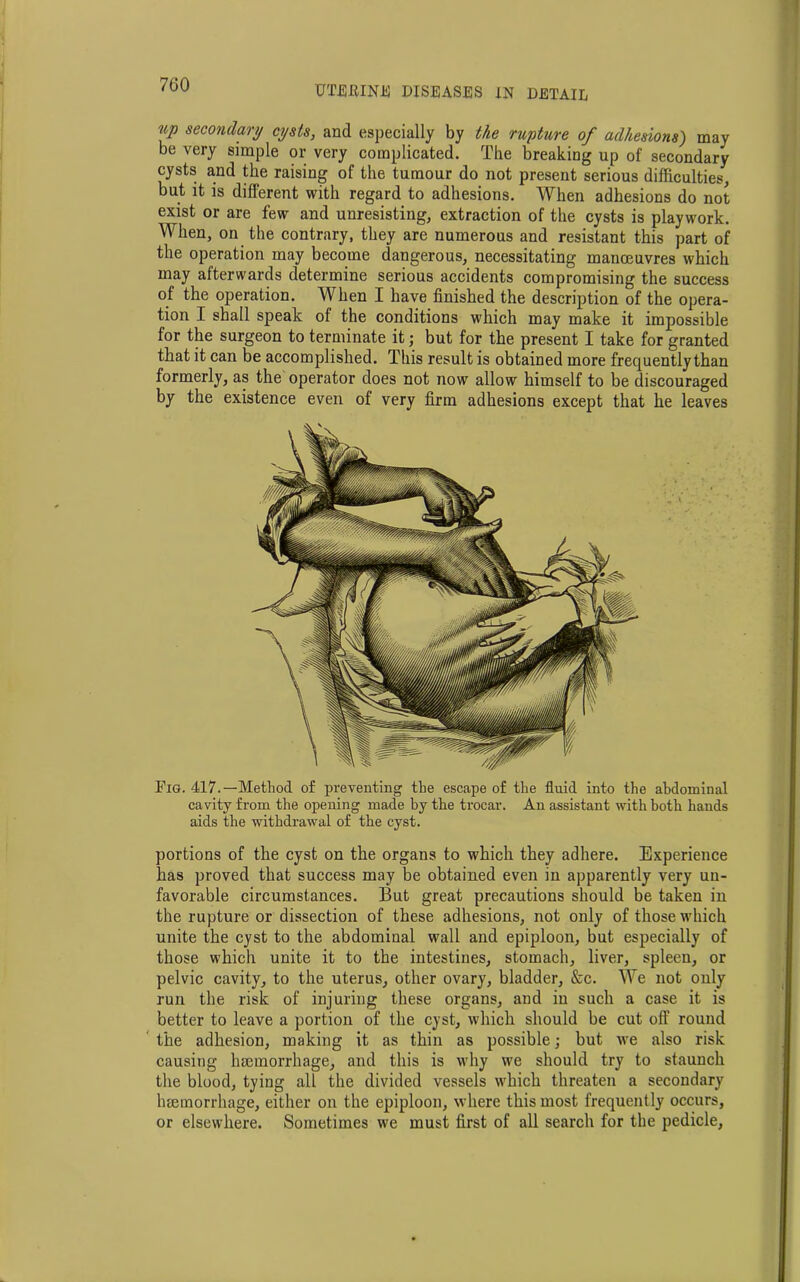 up secondary cysts, and especially by the rupture of adhesions) may be very simple or very complicated. The breaking up of secondary cysts and the raising of the tumour do not present serious difficulties, but it is different with regard to adhesions. When adhesions do not exist or are few and unresisting, extraction of the cysts is playwork. When, on the contrary, they are numerous and resistant this part of the operation may become dangerous, necessitating manoeuvres which may afterwards determine serious accidents compromising the success of the operation. When I have finished the description of the opera- tion I shall speak of the conditions which may make it impossible for the surgeon to terminate it; but for the present I take for granted that it can be accomplished. This result is obtained more frequently than formerly, as the operator does not now allow himself to be discouraged by the existence even of very firm adhesions except that he leaves Pig. 417.—Method of preventing the escape of the fluid into the abdominal cavity from the opening made by the trocar. An assistant with both hands aids the withdrawal of the cyst. portions of the cyst on the organs to which they adhere. Experience has proved that success may be obtained even in apparently very un- favorable circumstances. But great precautions should be taken in the rupture or dissection of these adhesions, not only of those which unite the cyst to the abdominal wall and epiploon, but especially of those which unite it to the intestines, stomach, liver, spleen, or pelvic cavity, to the uterus, other ovary, bladder, &c. We not only run the risk of injuring these organs, and in such a case it is better to leave a portion of the cyst, which should be cut off round the adhesion, making it as thin as possible; but we also risk causing haemorrhage, and this is why we should try to staunch the blood, tying all the divided vessels which threaten a secondary haemorrhage, either on the epiploon, where this most frequently occurs, or elsewhere. Sometimes we must first of all search for the pedicle,