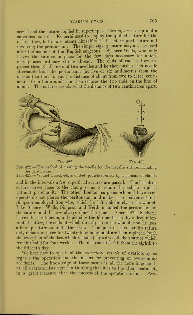 seized and the suture applied in superimposed layers, i.e. a deep and a superficial suture. Kceberle used to employ the quilled suture for the deep suture, but now contents himself with the interrupted suture not involving the peritoneum. The simple zigzag suture may also be used after the manner of the English surgeons. Spencer Wells, who only leaves the sutures in place for the few days necessary for union, merely uses ordinary strong thread. The ends of each suture are passed through the eyes of two needles and he then pushes each needle alternately from the peritoneum (at five or six millimetres from the incision) to the skin (at the distance of about from two to three centi- metres from the wound), he then secures the two ends on the line of union. The sutures are placed at the distance of two centimetres apart, Fig. 422. Fig. 423. Fig. 422.—The method of passing the needle for the metallic suture, including the peritoneum. Fig. 423.—Wound closed, edges united, pedicle secured hy a permanent clamp. and in the intervals a few superficial sutures are passed. The last deep suture passes close to the clamp so as to retain the pedicle in place without piercing it. The other London surgeons whom I have seen operate do not pierce the peritoneum and make use of silver sutures. Simpson employed iron wire, which he left indefinitely in the wound. Like Spencer Wells, Simpson and Keith included the peritoneum in the suture, and I have always done the same. Since 1874 Kceberle leaves the peritoneum, only piercing the fibrous tissues by a deep inter- rupted suture, the ends of which directly cross the wound, and he uses a harelip suture to unite the skin. The pins of this harelip suture only remain in place for twenty-four hours and are then replaced (with the exception of the last which remains) by a dry collodion suture which remains solid for four weeks. The deep sutures fall from the eighth to the fifteenth day. We have now to speak of the immediate results of ovariotomy as regards the operation and the means for preventing or overcoming accidents. The knowledge of these means is all the more important, as all ovariotomists agree in thinking that it is to the after-treatment, in a great measure, that the success of the operation is due. Acci-