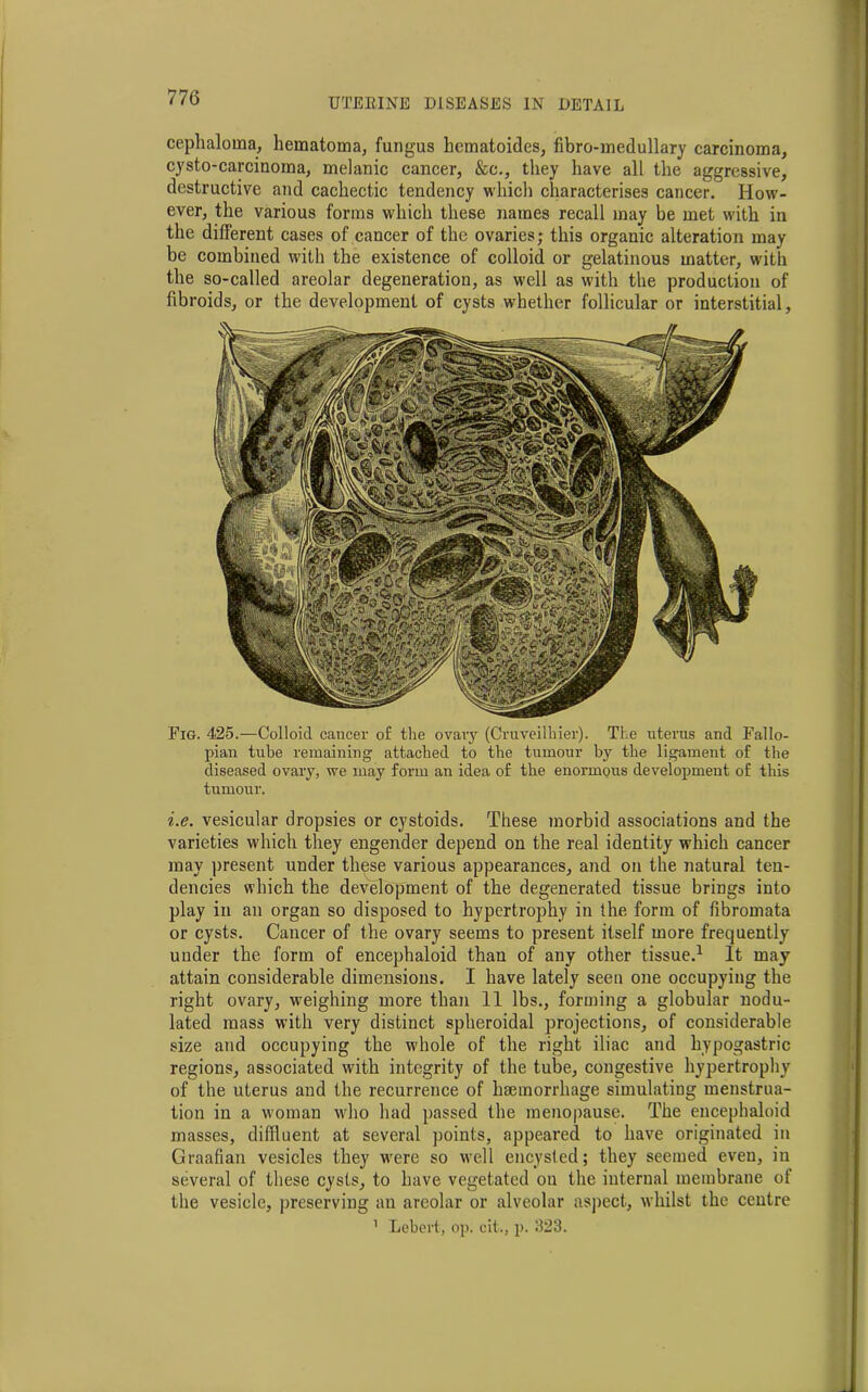 cephaloma, hematoma, fungus hcmatoides, fibre-medullary carcinoma, cysto-carcinoma, melanic cancer, &c., they have all the aggressive, destructive and cachectic tendency which characterises cancer. How- ever, the various forms which these names recall may be met with in the different cases of cancer of the ovaries; this organic alteration may be combined with the existence of colloid or gelatinous matter, with the so-called areolar degeneration, as well as with the production of fibroids, or the development of cysts whether follicular or interstitial, Fig. 425.—Colloid cancer of the ovary (Cruveilhier). The uterus and Fallo- pian tube remaining attached to the tumour by the ligament of the diseased ovary, we may form an idea of the enormous development of this tumour. i.e. vesicular dropsies or cystoids. These morbid associations and the varieties which they engender depend on the real identity which cancer may present under these various appearances, and on the natural ten- dencies which the development of the degenerated tissue brings into play in an organ so disposed to hypertrophy in the form of fibromata or cysts. Cancer of the ovary seems to present itself more frequently under the form of encephaloid than of any other tissue.1 It may attain considerable dimensions. I have lately seen one occupying the right ovary, weighing more than 11 lbs., forming a globular nodu- lated mass with very distinct spheroidal projections, of considerable size and occupying the whole of the right iliac and hypogastric regions, associated with integrity of the tube, congestive hypertrophy of the uterus and the recurrence of haemorrhage simulating menstrua- tion in a woman who had passed the menopause. The encephaloid masses, diffluent at several points, appeared to have originated in Graafian vesicles they were so well encysted; they seemed eveu, in several of these cysts, to have vegetated on the internal membrane of the vesicle, preserving an areolar or alveolar aspect, whilst the centre 1 Lebert, op. cit., p. 323.