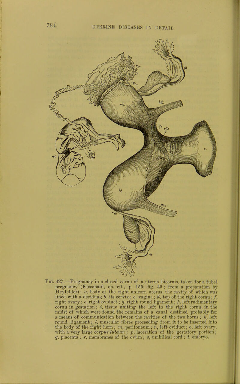 781. Fig. 427.—Pregnancy in a closed cornu of a uterus bicornis, taken for a tubal pregnancy (Kussmaul, op. cit., p. loo, fig. 45 ; from a preparation by Heyfelder) : a, body of the right unicorn uterus, the cavity of which was lined with a decidua4 b, its cervix ; c, vagina ; d, top of the right cornu ;/, right ovary; e, right oviduct; g, right round ligament; h, left rudimentary cornu in gestation; i, tissue uniting the left to the right cornu, in the midst of which were found the remains of a canal destined probably for a means of communication between the cavities of the two horns ; k, left round ligament; l, muscular fibres proceeding from it to be inserted into the body of the right horn ; to, peritoneum ; n, left oviduct; 0, left ovary, with a very large corpus luteum ; p, laceration of the gestatory portion ; q, placenta; r, membranes of the ovum ; s, umbilical cord ; t, embryo.