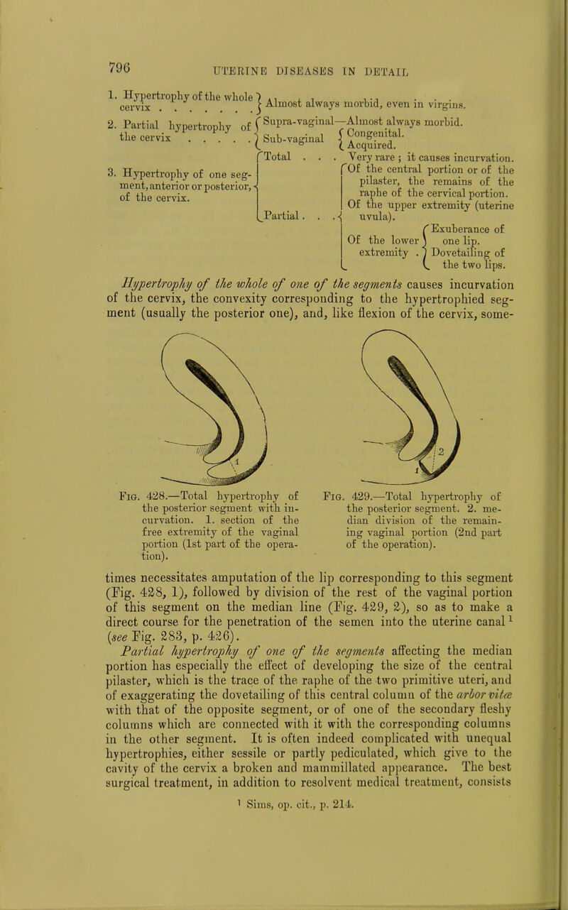 1. Hypertrophy of the whole1 A1 , , ... cervix . C Almost always morbid, even in virgins. 2. Partial hypertrophy of f Supra-vaginal—Almost always morbid, the cervix . Snkv^n.l (Congenital. t Hypertrophy of one seg- ment, anterior or posterior, of the cervix. Sub-vaginal Total . Partial, i Acquired. Very rare ; it causes incurvation. Of the central portion or of the pilaster, the remains of the raphe of the cervical portion. Of the upper extremity (uterine uvula). ^Exuberance of Of the lower \ one lip. extremity . 1 Dovetailing of (. the two lips. Hypertrophy of the whole of one of the segments causes incurvation of the cervix, the convexity corresponding to the hypertrophied seg- ment (usually the posterior one), and, like flexion of the cervix, some- Fig. 428.—Total hypertrophy of the posterior segment with in- curvation. 1. section of the free extremity of the vaginal portion (1st part of the opera- tion). Fig. 429.—Total hypertrophy of the posterior segment. 2. me- dian division of the remain- ing vaginal portion (2nd part of the operation). times necessitates amputation of the lip corresponding to this segment (Fig. 428, 1), followed by division of the rest of the vaginal portion of this segment on the median line (Fig. 429, 2), so as to make a direct course for the penetration of the semen into the uterine canal1 (see Fig. 283, p. 426). Partial hypertrophy of one of the segments affecting the median portion has especially the effect of developing the size of the central pilaster, which is the trace of the raphe of the two primitive uteri, and of exaggerating the dovetailing of this central column of the arbor vitee with that of the opposite segment, or of one of the secondary fleshy columns which are connected with it with the corresponding columns in the other segment. It is often indeed complicated with unequal hypertrophies, either sessile or partly pediculated, which give to the cavity of the cervix a broken and mammiilated appearance. The best surgical treatment, in addition to resolvent medical treatment, consists