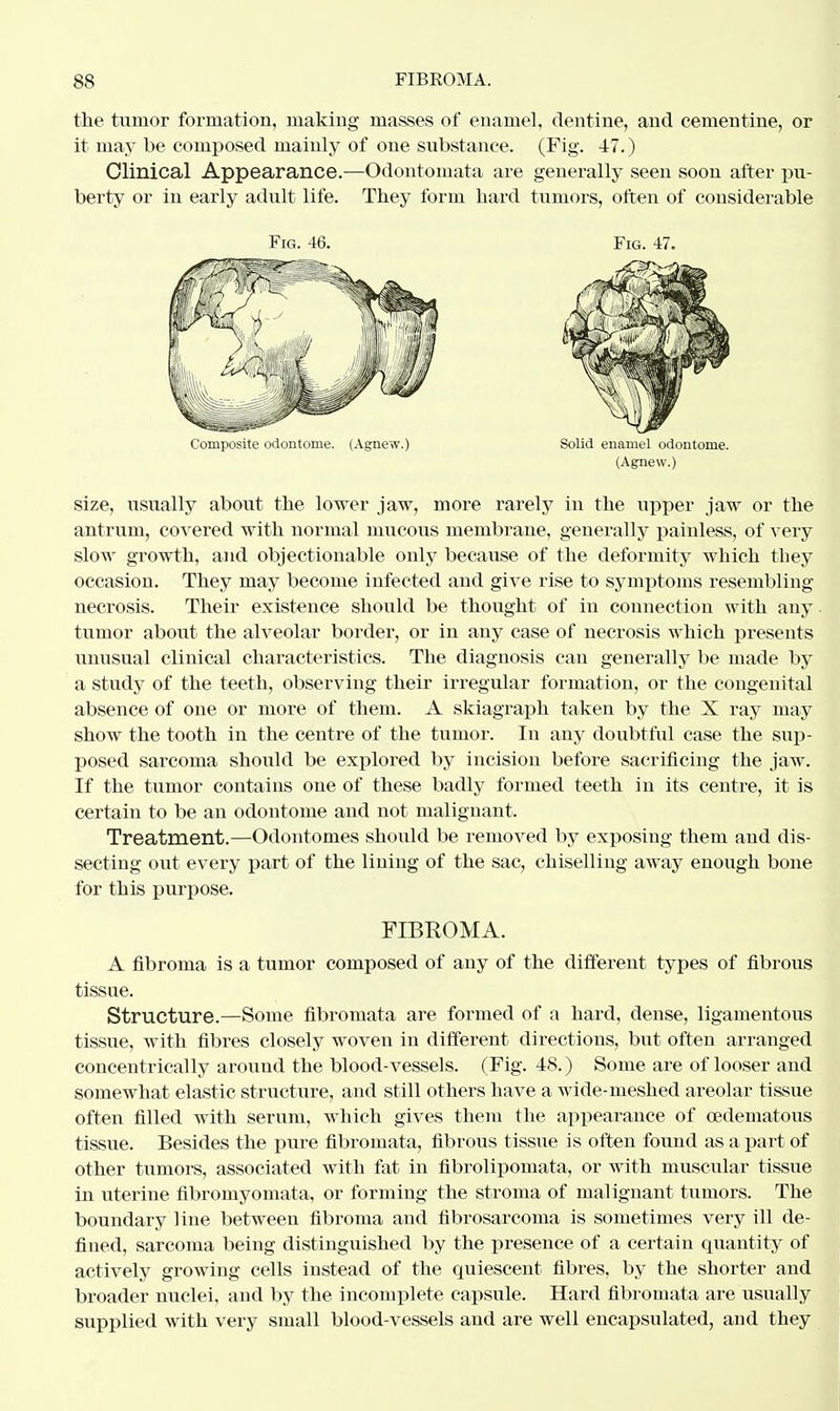 the tumor formation, making masses of enamel, dentine, and ceinentine, or it may be composed mainly of one substance. (Fig. 47.) Clinical Appearance.—Odontomata are generally seen soon after pu- berty or in early adult life. They form hard tumors, often of considerable Fig. 46. Fig. 47. Composite odontome. (Agnew.) Solid enamel odontome. (Agnew.) size, usually about the lower jaw, more rarely in the upper jaw or the antrum, covered with normal mucous membrane, generally painless, of very slow growth, and objectionable only because of the deformity which tliey occasion. They may become infected and give rise to symptoms resembling necrosis. Their existence should be thought of in connection with any tumor about the alveolar border, or in any case of necrosis which presents unusual clinical characteristics. The diagnosis can generally be made by a study of the teeth, observing their irregular formation, or the congenital absence of one or more of them. A skiagraph taken by the X ray may show the tooth in the centre of the tumor. In any doubtful case the sup- posed sarcoma should be explored by incision before sacrificing the jaw. If the tumor contains one of these badly formed teeth in its centre, it is certain to be an odontome and not malignant. Treatment.—Odontomes should be removed by exposing them and dis- secting out every part of the lining of the sac, chiselling away enough bone for this purpose. FIBROMA. A fibroma is a tumor composed of any of the different types of fibrous tissue. Structure.—Some fibromata are formed of a hard, dense, ligamentous tissue, with fibres closely woven in different directions, but often arranged concentrically around the blood-vessels. (Fig. 48.) Some are of looser and somewhat elastic structure, and still others have a wide-meshed areolar tissue often filled with serum, which gives them the appearance of cedematous tissue. Besides the pure fibromata, fibrous tissue is often found as a part of other tumors, associated with fat in fibrolipomata, or with muscular tissue in uterine fibromyomata, or forming the stroma of malignant tumors. The boundary line between fibroma and fibrosarcoma is sometimes very ill de- fined, sarcoma being distinguished by the presence of a certain quantity of actively growing cells instead of the quiescent fibres, by the shorter and broader nuclei, and by the incomplete capsule. Hard fibromata are usually supplied with very small blood-vessels and are well encapsulated, and they