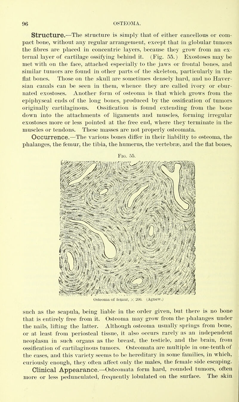 Structure.—The structure is simply that of either cancellous or com- pact bone, without any regular arrangement, except that in globular tumors the fibres are placed in concentric layers, because they grow from an ex- ternal layer of cartilage ossifying behind it. (Fig. 55.) Exostoses may be met with on the face, attached especially to the jaws or frontal bones, and similar tumors are found in other parts of the skeleton, particularly in the flat bones. Those on the skull are sometimes densely hard, and no Haver- sian canals can be seen in them, whence they are called ivory or ebur- nated exostoses. Another form of osteoma is that which grows from the epiphyseal ends of the long bones, produced by the ossification of tumors originally cartilaginous. Ossification is found extending from the bone down into the attachments of ligaments and muscles, forming irregular exostoses more or less pointed at the free end, where they terminate in the muscles or tendons. These masses are not properly osteomata. Occurrence.—The various bones differ in their liability to osteoma, the phalanges, the femur, the tibia, the humerus, the vertebrae, and the flat bones, Hi mif ^ Osteoma of femur, x 200. (Aguew.) such as the scapula, being liable in the order given, but there is no bone that is entirely free from it. Osteoma may grow from the phalanges under the nails, lifting the latter. Although osteoma usually springs from bone, or at least from periosteal tissue, it also occurs rarely as an independent neoplasm in such organs as the breast, the testicle, and the brain, from ossification of cartilaginous tumors. Osteomata are multiple in one-tenth of the cases, and this variety seems to be hereditary in some families, in which, curiously enough, they often affect only the males, the female side escaping. Clinical Appearance.—Osteomata form hard, rounded tumors, often more or less pedunculated, frequently lobulated on the surface. The skin