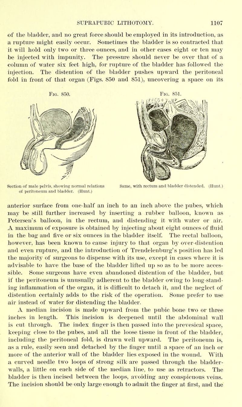 of the bladder, and no great force should be employed in its introduction, as a rupture might easily occur. Sometimes the bladder is so contracted that it will hold only two or three ounces, and in other cases eight or ten may be injected with impunity. The pressure should never be over that of a column of water six feet high, for rupture of the bladder has followed the injection. The distention of the bladder pushes upward the peritoneal fold in front of that organ (Figs. 850 and 851), uncovering a space on its Fig. 850. Fig. 851 Section of male pelvis, showing normal relations Same, with rectum and bladder distended. (Hunt.) of peritoneum and bladder. (Hunt.) anterior surface from one-half an inch to an inch above the pubes, which may be still further increased by inserting a rubber balloon, known as Petersen's balloon, in the rectum, and distending it with water or air. A maximum of exposure is obtained by injecting about eight ounces of fluid in the bag and five or six ounces in the bladder itself. The rectal balloon, however, has been known to cause injury to that organ by over-distention and even rupture, and the introduction of Trendelenburg's position has led the majority of surgeons to dispense with its use, except in cases where it is advisable to have the base of the bladder lifted up so as to be more acces- sible. Some surgeons have even abandoned distention of the bladder, but if the peritoneum is unusually adherent to the bladder owing to long-stand- ing inflammation of the organ, it is difficult to detach it, and the neglect of distention certainly adds to the risk of the operation. Some prefer to use air instead of water for distending the bladder. A median incision is made upward from the pubic bone two or three inches in length. This incision is deepened until the abdominal wall is cut through. The index finger is then passed into the prevesical space, keeping close to the pubes, and all the loose tissue in front of the bladder, including the peritoneal fold, is drawn well upward. The peritoneum is, as a rule, easily seen and detached by the finger until a space of an inch or more of the anterior wall of the bladder lies exposed in the wound. With a curved needle two loops of strong silk are passed through the bladder- walls, a little on each side of the median line, to use as retractors. The bladder is then incised between the loops, avoiding any conspicuous veins. The incision should be only large enough to admit the finger at first, and the