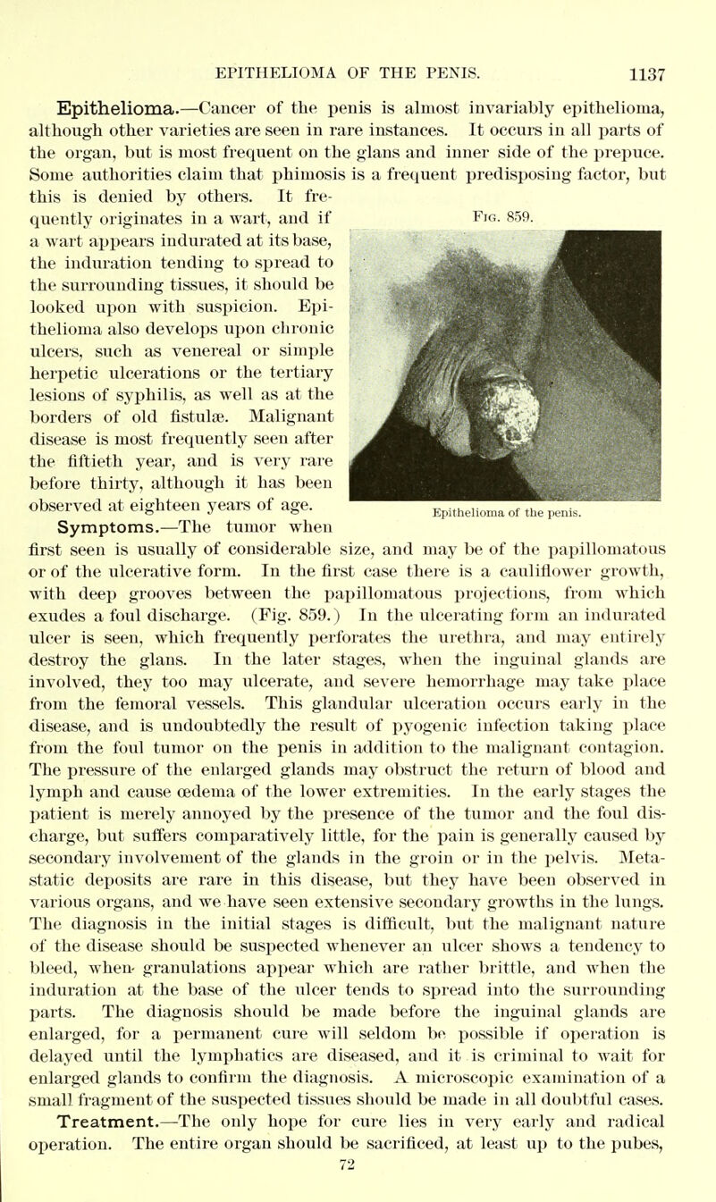 Epithelioma of the penis. Epithelioma.—Cancer of the penis is almost invariably epithelioma, although other varieties are seen in rare instances. It occurs in all parts of the organ, but is most frequent on the glans and inner side of the prepuce. Some authorities claim that phimosis is a frequent predisposing factor, but this is denied by others. It fre- quently originates in a wart, and if Fig. 859. a wart appears indurated at its base, the induration tending to spread to the surrounding tissues, it should be looked upon with suspicion. Epi- thelioma also develops upon chronic ulcers, such as venereal or simple herpetic ulcerations or the tertiary lesions of syphilis, as well as at the borders of old fistula?. Malignant disease is most frequently seen after the fiftieth year, and is very rare before thirty, although it has been observed at eighteen years of age. Symptoms.—The tumor when first seen is usually of considerable size, and may be of the papillomatous or of the ulcerative form. In the first case there is a cauliflower growth, with deep grooves between the papillomatous projections, from which exudes a foul discharge. (Fig. 859.) In the ulcerating form an indurated ulcer is seen, which frequently perforates the urethra, and may entirely destroy the glans. In the later stages, when the inguinal glands are involved, they too may ulcerate, and severe hemorrhage may take place from the femoral vessels. This glandular ulceration occurs early in the disease, and is undoubtedly the result of pyogenic infection taking place from the fold tumor on the penis in addition to the malignant contagion. The pressure of the enlarged glands may obstruct the return of blood and lymph and cause oedema of the lower extremities. In the early stages the patient is merely annoyed by the presence of the tumor and the foul dis- charge, but suffers comparatively little, for the pain is generally caused by secondary involvement of the glands in the groin or in the pelvis. Meta- static deposits are rare in this disease, but they have been observed in various organs, and we have seen extensive secondary growths in the lungs. The diagnosis in the initial stages is difficult, but the malignant nature of the disease should be suspected whenever an ulcer shows a tendency to bleed, when- granulations appear which are rather brittle, and when the induration at the base of the ulcer tends to spread into the surrounding parts. The diagnosis should be made before the inguinal glands are enlarged, for a permanent cure will seldom be possible if operation is delayed until the lymphatics are diseased, and it is criminal to wait for enlarged glands to confirm the diagnosis. A microscopic examination of a small fragment of the suspected tissues should be made in all doubtful cases. Treatment.—The only hope for cure lies in very early and radical operation. The entire organ should be sacrificed, at least up to the pubes, 72