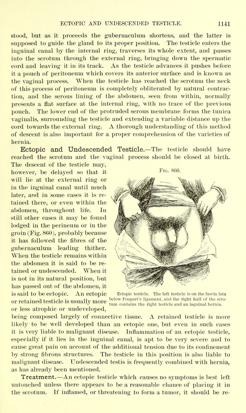 stood, but as it proceeds the gubernaculuni shortens, and the latter is supposed to guide the gland to its proper position. The testicle enters the inguinal canal by the internal ring, traverses its whole extent, and passes into the scrotum through the external ring, bringing down the spermatic cord and leaving it in its track. As the testicle advances it pushes before it a pouch of peritoneum which covers its anterior surface and is known as the vaginal process. When the testicle has reached the scrotum the neck of this process of peritoneum is completely obliterated by natural contrac- tion, and the serous lining of the abdomen, seen from within, normally presents a flat surface at the internal ring, with no trace of the previous pouch. The lower end of the protruded serous membrane forms the tunica vaginalis, surrounding the testicle and extending a variable distance up the cord towards the external ring. A thorough understanding of this method of descent is also important for a proper comprehension of the varieties of hernia. Ectopic and Undescended Testicle.—The testicle should have reached the scrotum and the vaginal process should be closed at birth. The descent of the testicle may, however, be delayed so that it FlG> 860- will lie at the external ring or in the inguinal canal until much later, and in some cases it is re- tained there, or even within the abdomen, throughout life. In still other cases it may be found lodged in the perineum or in the groin (Fig. 860), probably because it has followed the fibres of the gubernaculum leading thither. When the testicle remains within the abdomen it is said to be re- tained or undescended. When it is not in its natural position, but has passed out of the abdomen, it is said to be ectopic An ectopic or retained testicle is usually more or less atrophic or undeveloped, being composed largely of connective tissue. A retained testicle is more likely to be well developed than an ectopic one, but even in such cases it is very liable to malignant disease. Inflammation of an ectopic testicle, especially if it lies in the inguinal canal, is apt to be very severe and to cause great pain on account of the additional tension due to its confinement by strong fibrous structures. The testicle in this position is also liable to malignant disease. Undescended testis is frequently combined with hernia, as has already been mentioned. Treatment.—An ectopic testicle which causes no symptoms is best left untouched unless there appears to be a reasonable chance of placing it in the scrotum. If inflamed, or threatening to form a tumor, it .should be re- Ectopic testicle. The left testicle is on the fascia lata below Poupart's ligament, and the right half of the scro- tum contains the right testicle and an inguinal hernia.