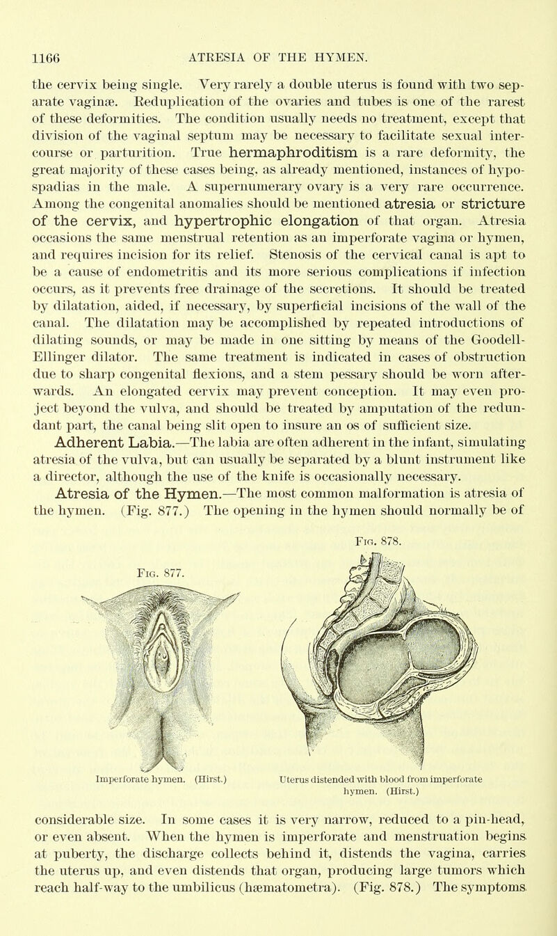 the cervix being single. Very rarely a double uterus is found with two sep- arate vaginae. Eeduplication of the ovaries and tubes is one of the rarest of these deformities. The condition usually needs no treatment, except that division of the vaginal septum may be necessary to facilitate sexual inter- course or parturition. True hermaphroditism is a rare deformity, the great majority of these cases being, as already mentioned, instances of hypo- spadias in the male. A supernumerary ovary is a very rare occurrence. Among the congenital anomalies should be mentioned atresia or stricture of the cervix, and hypertrophic elongation of that organ. Atresia occasions the same menstrual retention as an imperforate vagina or hymen, and requires incision for its relief. Stenosis of the cervical canal is apt to be a cause of endometritis and its more serious complications if infection occurs, as it prevents free drainage of the secretions. It should be treated by dilatation, aided, if necessary, by superficial incisions of the wall of the canal. The dilatation may be accomplished by repeated introductions of dilating sounds, or may be made in one sitting by means of the Goodell- Ellinger dilator. The same treatment is indicated in cases of obstruction due to sharp congenital flexions, and a stem pessary should be worn after- wards. An elongated cervix may prevent conception. It may even pro- ject beyond the vulva, and should be treated by amputation of the redun- dant part, the canal being slit open to insure an os of sufficient size. Adherent Labia.—The labia are often adherent in the infant, simulating atresia of the vulva, but can usually be separated by a blunt instrument like a director, although the use of the knife is occasionally necessary. Atresia of the Hymen.—The most common malformation is atresia of the hymen. (Fig. 877.) The opening in the hymen should normally be of considerable size. In some cases it is very narrow, reduced to a pin-head, or even absent. When the hymen is imperforate and menstruation begins at puberty, the discharge collects behind it, distends the vagina, carries the uterus up, and even distends that organ, producing large tumors which reach half-way to the umbilicus (hsematometra). (Fig. 878.) The symptoms Fi«. 878. Imperforate hymen. (Hirst.) Uterus distended with blood from imperforate hymen. (Hirst.)