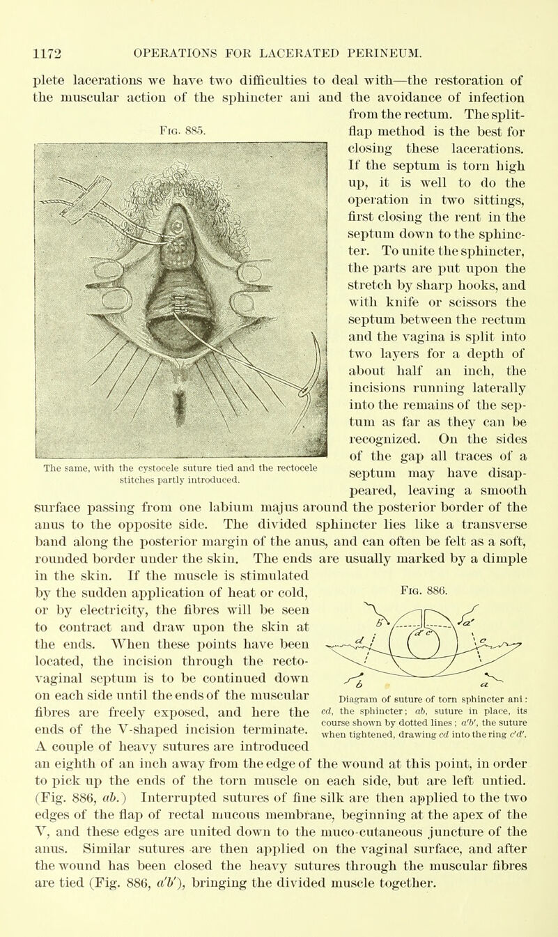 Fig. 885. plete lacerations we have two difficulties to deal with—the restoration of the muscular action of the sphincter ani and the avoidance of infection from the rectum. The split- flap method is the best for closing these lacerations. If the septum is torn high up, it is well to do the operation in two sittings, first closing the rent in the septum down to the sphinc- ter. To unite the sphincter, the parts are put upon the stretch by sharp hooks, and with knife or scissors the septum between the rectum and the vagina is split into two layers for a depth of about half an inch, the incisions running laterally into the remains of the sep- tum as far as they can be recognized. On the sides of the gap all traces of a septum may have disap- peared, leaving a smooth surface passing from one labium majus around the posterior border of the anus to the opposite side. The divided sphincter lies like a transverse band along the posterior margin of the anus, and can often be felt as a soft, rounded border under the skin. The ends are usually marked by a dimple in the skin. If the muscle is stimulated by the sudden application of heat or cold, or by electricity, the fibres will be seen to contract and draw upon the skin at the ends. When these points have been located, the incision through the recto- vaginal septum is to be continued down on each side until the ends of the muscular fibres are freely exposed, and here the ends of the V-shaped incision terminate. A couple of heavy sutures are introduced an eighth of an inch away from the edge of the wound at this point, in order to pick up the ends of the torn muscle on each side, but are left untied. (Fig. 886, ah.) Interrupted sutures of fine silk are then applied to the two edges of the flap of rectal mucous membrane, beginning at the apex of the V, and these edges are united down to the muco cutaneous juncture of the anus. Similar sutures are then applied on the vaginal surface, and after the wound has been closed the heavy sutures through the muscular fibres are tied (Fig. 886, a'b'), bringing the divided muscle together. The same, with the cystoeele suture tied and stitches partly introduced. Diagram of suture of torn sphincter ani: cd, the sphincter; ab, suture in place, its course shown by dotted lines; a'b', the suture when tightened, drawing cd, into the ring dd'.