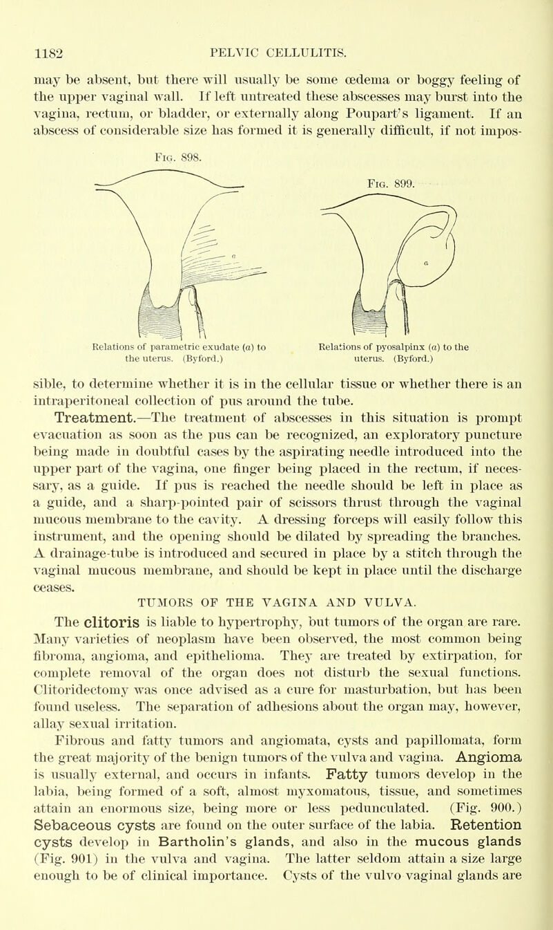 may be absent, but there will usually be some oedema or boggy feeling of the upper vaginal wall. If left untreated these abscesses may burst into the vagina, rectum, or bladder, or externally along Poupart's ligament. If an abscess of considerable size has formed it is generally difficult, if not impos- Fig. 898. Relations of parametric exudate (a) to Relations of pyosalpinx (a) to the the uterus. (Byford.) uterus. (Byford.) sible, to determine whether it is in the cellular tissue or whether there is an intraperitoneal collection of pus around the tube. Treatment.—The treatment of abscesses in this situation is prompt evacuation as soon as the pus can be recognized, an exploratory puncture being made in doubtful cases by the aspirating needle introduced into the upper part of the vagina, one finger being placed in the rectum, if neces- sary, as a guide. If pus is reached the needle should be left in place as a guide, and a sharp-pointed pair of scissors thrust through the vaginal mucous membrane to the cavity. A dressing forceps will easily follow this instrument, and the opening should be dilated by spreading the branches. A drainage-tube is introduced and secured in place by a stitch through the vaginal mucous membrane, and should be kept in place until the discharge ceases. TUMOKS OP THE VAGINA AND VULVA. The clitoris is liable to hypertrophy, but tumors of the organ are rare. Many varieties of neoplasm have been observed, the most common being fibroma, angioma, and epithelioma. They are treated by extirpation, for complete removal of the organ does not disturb the sexual functions. Clitoridectomy was once advised as a cure for masturbation, but has been found useless. The separation of adhesions about the organ may, however, allay sexual irritation. Fibrous and fatty tumors and angiomata, cysts and papillomata, form the great majority of the benign tumors of the vulva and vagina. Angioma is usually external, and occurs in infants. Fatty tumors develop in the labia, being formed of a soft, almost myxomatous, tissue, and sometimes attain an enormous size, being more or less pedunculated. (Fig. 900.) Sebaceous cysts are found on the outer surface of the labia. Retention cysts develop in Bartholin's glands, and also in the mucous glands (Fig. 901) in the vulva and vagina. The latter seldom attain a size large enough to be of clinical importance. Cysts of the vulvo vaginal glands are