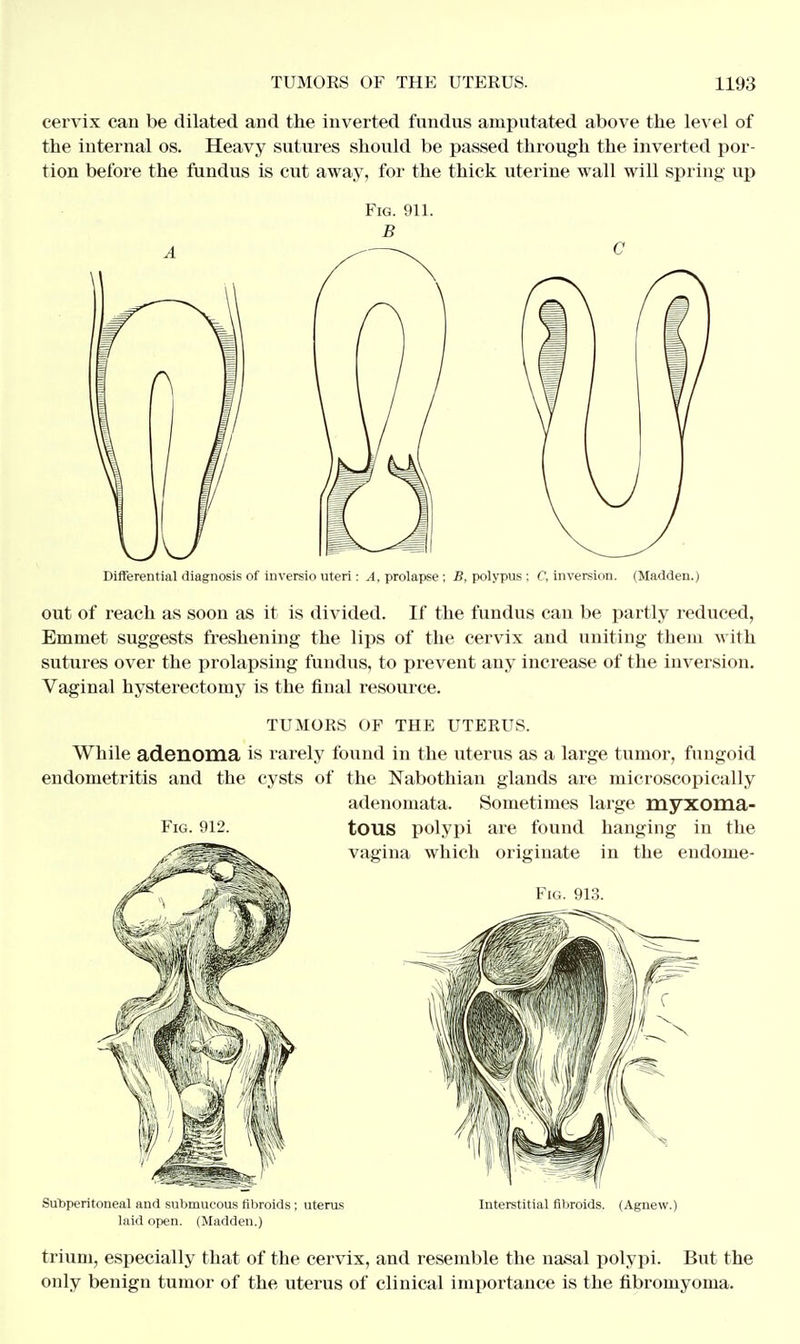 cervix can be dilated and the inverted fundus amputated above the level of the internal os. Heavy sutures should be passed through the inverted por- tion before the fundus is cut away, for the thick uterine wall will spring up Differential diagnosis of inversio uteri : A, prolapse; B, polypus : C, inversion. (Madden.) out of reach as soon as it is divided. If the fundus can be partly reduced, Emmet suggests freshening the lips of the cervix and uniting them with sutures over the prolapsing fundus, to prevent any increase of the inversion. Vaginal hysterectomy is the final resource. TUMORS OF THE UTERUS. While adenoma is rarely found in the uterus as a large tumor, fungoid endometritis and the cysts of the Nabothian glands are microscopically adenomata. Sometimes large myxoma- Fig. 912. tOUS polypi are found hanging in the vagina which originate in the endome- Fig. 913. Subperitoneal and submucous fibroids ; uterus laid open. (Madden.) Interstitial fibroids. (Agnew.) trium, especially that of the cervix, and resemble the nasal polypi. But the only benign tumor of the uterus of clinical importance is the fibromyoma.