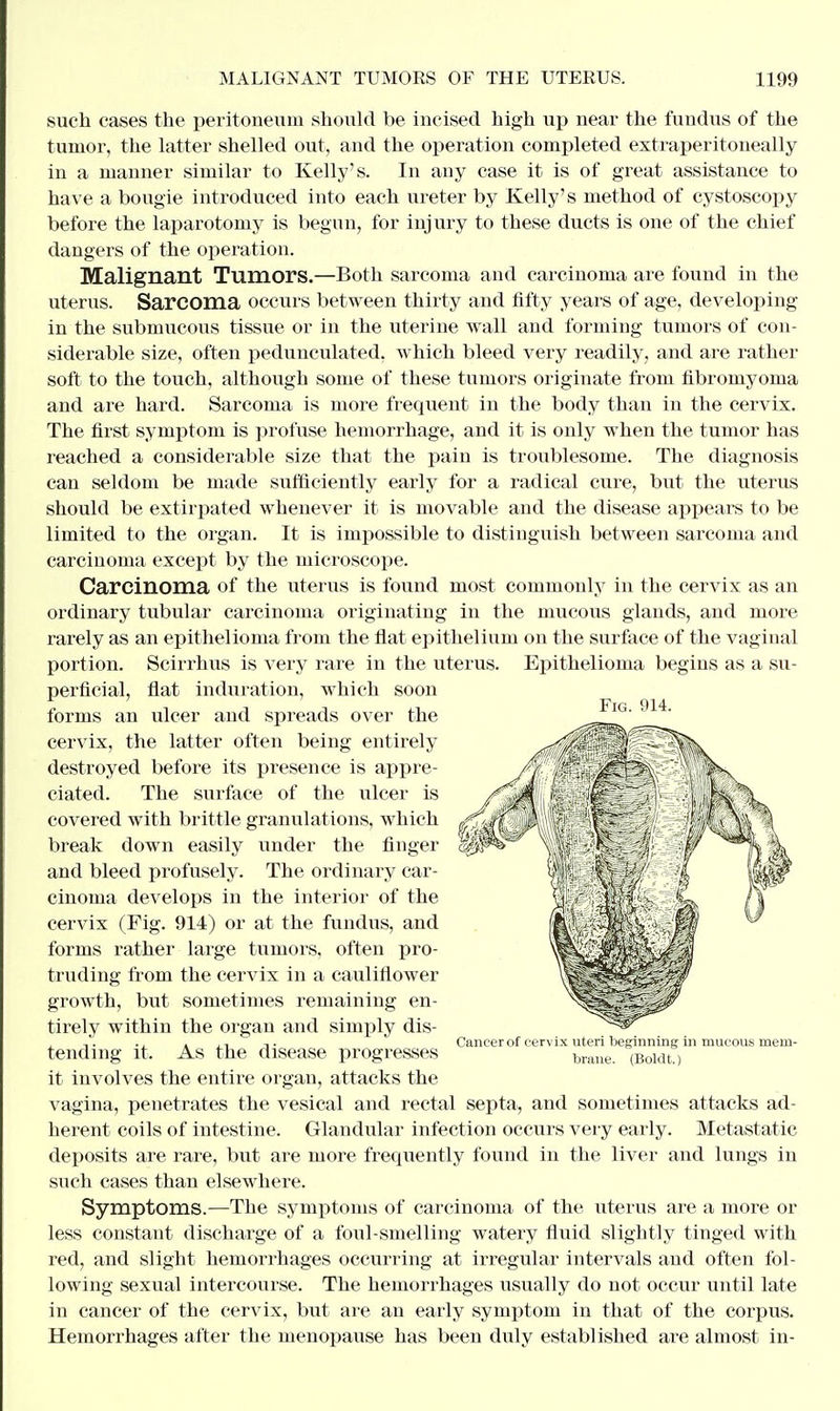 Fig. 914. such cases the peritoneum should be incised high up near the fundus of the tumor, the latter shelled out, and the operation completed extraperitoneally in a manner similar to Kelly's. In any case it is of great assistance to have a bougie introduced into each ureter by Kelly's method of cystoscopy before the laparotomy is begun, for injury to these ducts is one of the chief dangers of the operation. Malignant Tumors.—Both sarcoma and carcinoma are found in the uterus. Sarcoma occurs between thirty and fifty years of age, developing in the submucous tissue or in the uterine wall and forming tumors of con- siderable size, often pedunculated, which bleed very readily, and are rather soft to the touch, although some of these tumors originate from fibromyoma and are hard. Sarcoma is more frequent in the body than in the cervix. The first symptom is profuse hemorrhage, and it is only when the tumor has reached a considerable size that the pain is troublesome. The diagnosis can seldom be made sufficiently early for a radical cure, but the uterus should be extirpated whenever it is movable and the disease appears to be limited to the organ. It is impossible to distinguish between sarcoma and carcinoma except by the microscope. Carcinoma of the uterus is found most commonly in the cervix as an ordinary tubular carcinoma originating in the mucous glands, and more rarely as an epithelioma from the flat epithelium on the surface of the vaginal portion. Scirrhus is very rare in the uterus. Epithelioma begins as a su- perficial, flat induration, which soon forms an ulcer and spreads over the cervix, the latter often being entirely destroyed before its presence is appre- ciated. The surface of the ulcer is covered with brittle granulations, which break down easily under the finger and bleed profusely. The ordinary car- cinoma develops in the interior of the cervix (Fig. 914) or at the fundus, and forms rather large tumors, often pro- truding from the cervix in a cauliflower growth, but sometimes remaining en- tirely within the organ and simply dis- tending it. As the disease progresses it involves the entire organ, attacks the vagina, penetrates the vesical and rectal septa, and sometimes attacks ad- herent coils of intestine. Glandular infection occurs very early. Metastatic deposits are rare, but are more frequently found in the liver and lungs in such cases than elsewhere. Symptoms.—The symptoms of carcinoma of the uterus are a more or less constant discharge of a foul-smelling watery fluid slightly tinged with red, and slight hemorrhages occurring at irregular intervals and often fol- lowing sexual intercourse. The hemorrhages usually do not occur until late in cancer of the cervix, but are an early symptom in that of the corpus. Hemorrhages after the menopause has been duly established are almost in- Cancerof cervix uteri beginning in mucous mem- brane. (Boldt.)