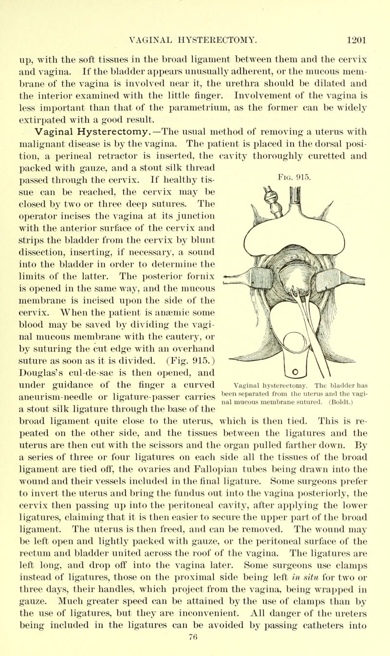 Fig. 915. up, with the soft tissues in the broad ligament between them and the cervix and vagina. If the bladder appears unusually adherent, or the mucous mem- brane of the vagina is involved near it, the urethra should be dilated and the interior examined with the little finger. Involvement of the vagina is less important than that of the parametrium, as the former can be widely extirpated with a good result- Vaginal Hysterectomy.—The usual method of removing a uterus with malignant disease is by the vagina. The patient is placed in the dorsal posi- tion, a perineal retractor is inserted, the cavity thoroughly curetted and packed with gauze, and a stout silk thread passed through the cervix. If healthy tis- sue can be reached, the cervix may be closed by two or three deep sutures. The operator incises the vagina at its junction with the anterior surface of the cervix and strips the bladder from the cervix by blunt dissection, inserting, if necessary, a sound into the bladder in order to determine the limits of the latter. The posterior fornix is opened in the same way, and the mucous membrane is incised upon the side of the cervix. When the patient is anaemic some blood may be saved by dividing the vagi- nal mucous membrane with the cautery, or by suturing the cut edge with an overhand suture as soon as it is divided. (Fig. 915.) Douglas's cul-de-sac is then opened, and under guidance of the finger a curved aneurism-needle or ligature-passer carries a stout silk ligature through the base of the broad ligament quite close to the uterus, which is then tied. This is re- peated on the other side, and the tissues between the ligatures and the uterus are then cut with the scissors and the organ pulled farther down. By a series of three or four ligatures on each side all the tissues of the broad ligament are tied off, the ovaries and Fallopian tubes being drawn into the wound and their vessels included in the final ligature. Some surgeons prefer to invert the uterus and bring the fundus out into the vagina posterioiiy, the cervix then passing up into the peritoneal cavity, after applying the lower ligatures, claiming that it is then easier to secure the upper part of the broad ligament. The uterus is then freed, and can be removed. The wound may be left open and lightly packed with gauze, or the peritoneal surface of the rectum and bladder united across the roof of the vagina. The ligatures are left long, and drop off into the vagina later. Some surgeons use clamps instead of ligatures, those on the proximal side being left in situ for two or three days, their handles, which project from the vagina, being wrapped in gauze. Much greater speed can be attained by the use of clamps than by the use of ligatures, but they are inconvenient. All danger of the ureters being included in the ligatures can be avoided by passing catheters into 76 Vaginal hysterectomy. The bladder has been separated from the uterus and the vagi- nal mucous membrane sutured. (Boldt.)