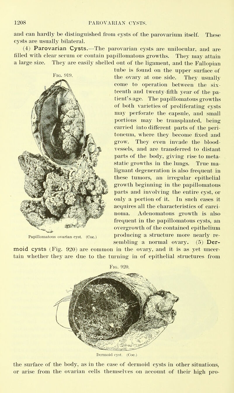 and can hardly be distinguished from cysts of the parovarium itself. These cysts are usually bilateral. (4) Parovarian Cysts.—The parovarian cysts are unilocular, and are filled with clear serum or contain papillomatous growths. They may attain a large size. They are easily shelled out of the ligament, and the Fallopian tube is found on the upper surface of the ovary at one side. They usually come to operation between the six- teenth and twenty-fifth year of the pa- tient's age. The papillomatous growths of both varieties of proliferating cysts may perforate the capsule, and small portions may be transplanted, being carried into different parts of the peri- toneum, where they become fixed and grow. They even invade the blood- vessels, and are transferred to distant parts of the body, giving rise to meta- static growths in the lungs. True ma- lignant degeneration is also frequent in these tumors, an irregular epithelial growth beginning in the papillomatous parts and involving the entire cyst, or only a portion of it. In such cases it acquires all the characteristics of carci- noma. Adenomatous growth is also frequent in the papillomatous cysts, an overgrowth of the contained epithelium producing a structure more nearly re- sembling a normal ovary. (5) Der- moid cysts (Fig. 920) are common in the ovary, and it is as yet uncer- tain whether they are due to the turning in of epithelial structures from Fig. 920. Dermoid cyst. (Coe.) the surface of the body, as in the case of dermoid cysts in other situations, or arise from the ovarian cells themselves on account of their high pro- Fig. 919. Papillomatous ovarian cyst. (Coe.)