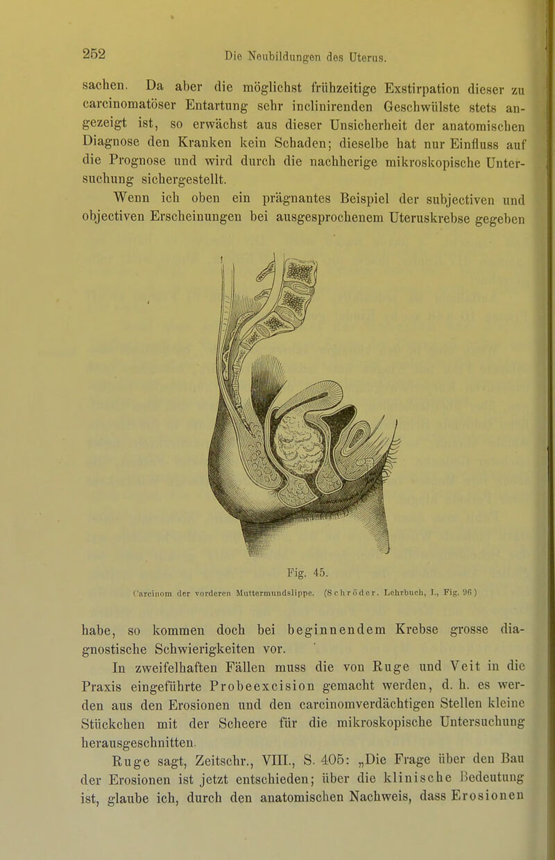 Sachen. Da aber die möglichst frühzeitige Exstirpation dieser zu carcinomatöser Entartung sehr inclinirenden Geschwülste stets an- gezeigt ist, so erwächst aus dieser Unsicherheit der anatomischen Diagnose den Kranken kein Schaden; dieselbe hat nur Einfluss auf die Prognose und wird durch die nachherige mikroskopische Unter- suchung sichergestellt. Wenn ich oben ein prägnantes Beispiel der subjectiven und objectiven Erscheinungen bei ausgesprochenem Uteruskrebse gegeben Fig. 45. Cnrcinom der vorderen Mnttermundslippe. (Schröder. Lehrbuch, I., Fig.'.)(!) habe, so kommen doch bei beginnendem Krebse grosse dia- gnostische Schwierigkeiten vor. In zweifelhaften Fällen muss die von Rüge und Veit in die Praxis eingeführte Probeexcision gemacht werden, d. h. es wer- den aus den Erosionen und den carcinomverdächtigen Stellen kleine Stückchen mit der Scheere für die mikroskopische Untersuchung herausgeschnitten. Rüge sagt, Zeitschr., VIII., S. 406: „Die Frage über den Bau der Erosionen ist jetzt entschieden; über die klinische Bedeutung ist, glaube ich, durch den anatomischen Nachweis, dass Erosionen