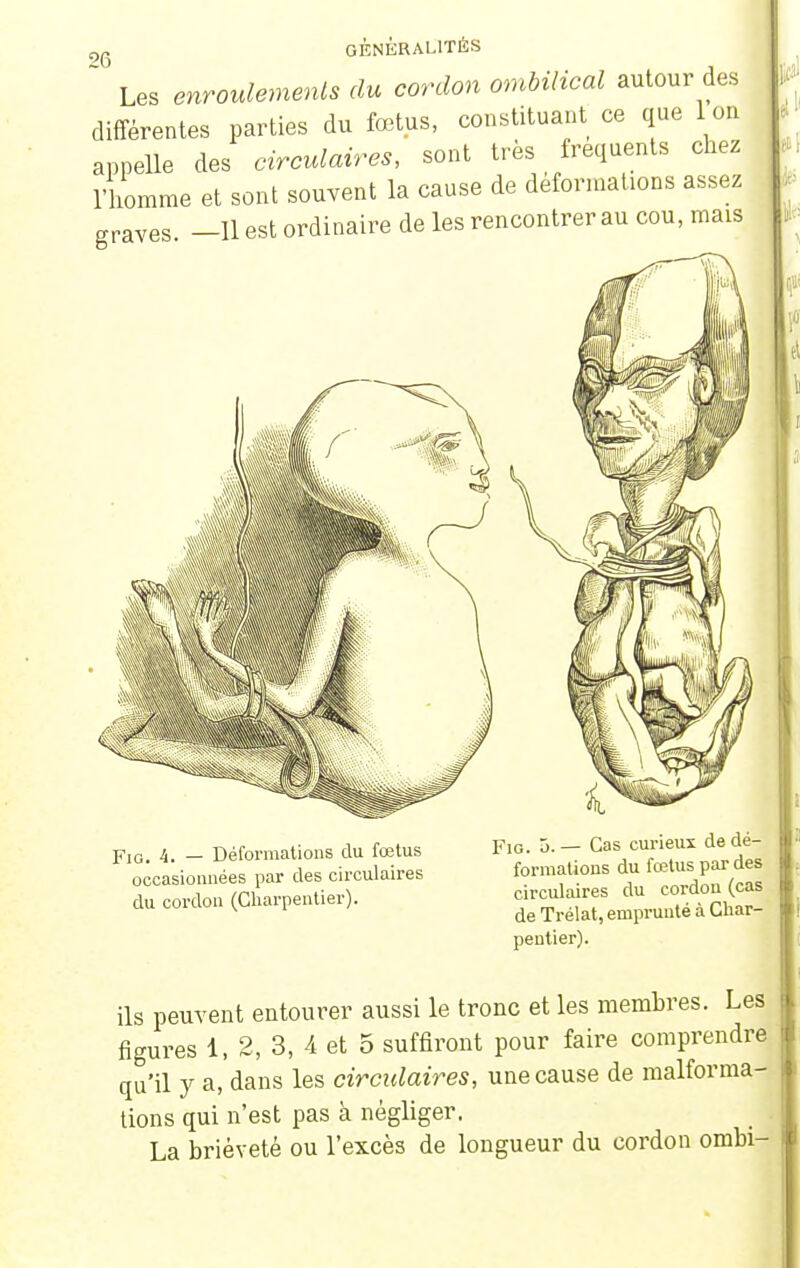 26 , Les enroulements du cordon ombilical autour des différentes parties du fœtus, constituant ce que 1 on appelle des circulaires, sont très fréquents chez l'homme et sont souvent la cause de déformations assez graves —11 est ordinaire de les rencontrer au cou, mais Fig. 4. — Déformations du fœtus occasionnées par des circulaires du cordon (Charpentier). Fio. 5.— Cas curieux de dé- formations du fœtus par des circulaires du cordon (cas de Trélat, emprunté à Char- pentier). ils peuvent entourer aussi le tronc et les membres. Les figures 1, 2, 3, 4 et 5 suffiront pour faire comprendre qu'il y a, dans les circidaires, une cause de malforma- tions qui n'est pas à négliger. La brièveté ou l'excès de longueur du cordon ombi-