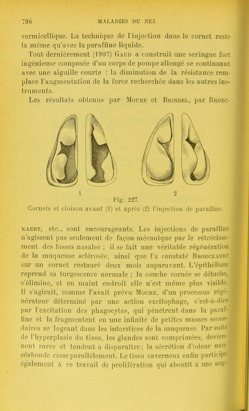 vermicellique. La technique de l'injection dans le cornet reste la même qu'avec la paraffine liquide. Tout dernièrement (1907) Gaud a construit une seringue fort ingénieuse composée d'un corps de pompe allongé se continuant avec une aiguille courte : la diminution de la résistance rem- place l'augmentation de la force recherchée dans les autres ins- truments. Les résultats obtenus par Moure et Brindel, par Broec- 1 2 Fi g. 227. Cornets et cloison avant (1) et après (2) l'injection de paraffine. IvAert, etc., sont encourageants. Les injections de paraffine n'agissent pas seulement de façon mécanique par le rétrécisse- ment des fosses nasales ; il se fait une véritable régénération de la muqueuse sclérosée, ainsi que l'a constaté Broeckaert sur un cornet restauré deux mois auparavant. L'épithélimn reprend sa turgescence normale ; la couche cornée se détache, s'élimine, et en maint endroit elle n'est même plus visible. 11 s'agirait, comme l'avait prévu Moure, d'un processus régé^ nérateur déterminé par une action excitophage, c'est-à-tliie par l'excitation des phagocytes, qui pénètrent dans la paraf- fine et la fragmentent en une infinité de petites masses secon- daires se logeant dans les interstices de la muqueuse. Par suite de l'hyperplasie du tissu, les glandes sont comprimées, devien- nent rares et tendent à disparaître; la sécrétion d'odeur nau- séabonde cesse parallèlement. Le tissu caverneux enfin participe également à ce travail de prolifération qui aboutit a une aug-