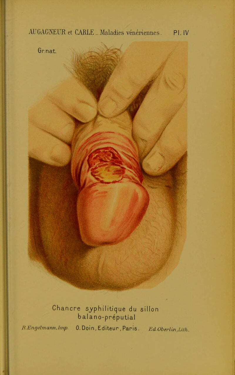 Gr nat. -i-O *j£5îFV Chancre syphilitique du sillon balano-préputial B.EnrjelmannJmp 0. Doin, Editeur, Paris . HdOberiinjÀth.
