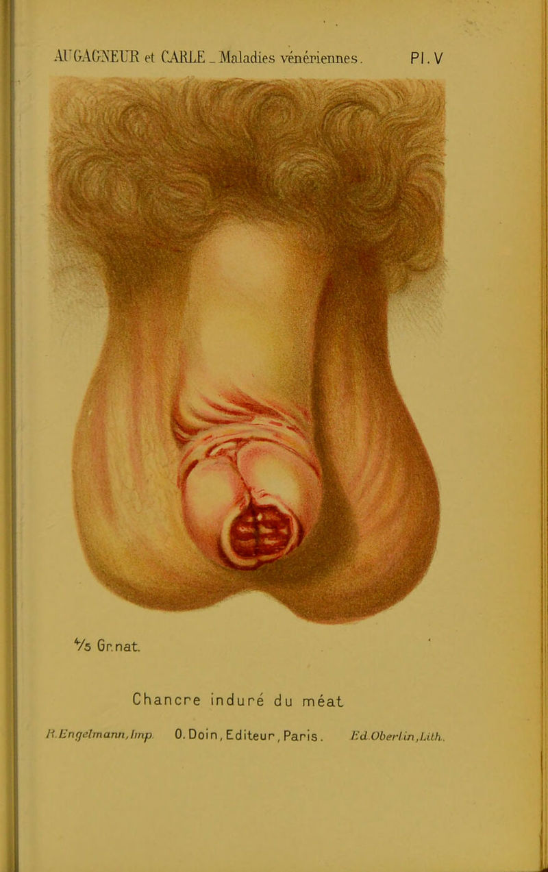 Chancre induré du méat