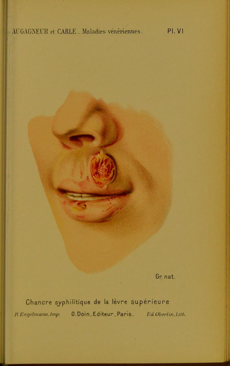 Chancre syphilitique de la lèvre supérieure R.Engélmttnn,ïmp. 0. Doin, Editeur, Paris. F.d ObeHin.LUh.