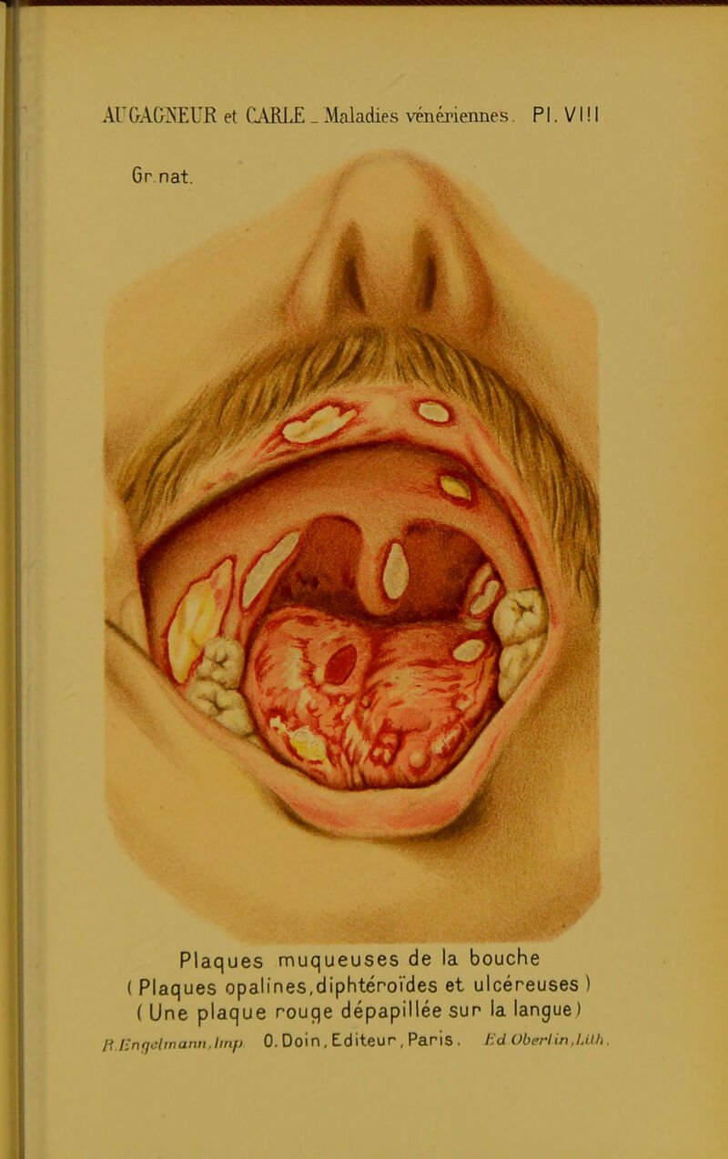 Gr nat. Plaques muqueuses de la bouche ( Plaques opalines,diphtéroïdes et ulcéreuses ) ( Une plaque rouqe dépapillée sur la langue)