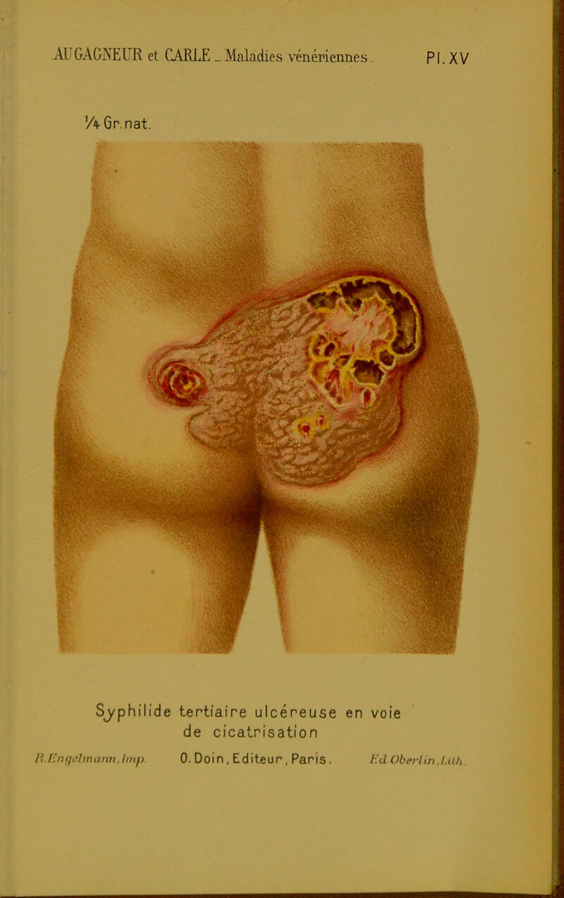 AU GAGNEUR et CARLE _ Maladies Pl.XV 'AGr.nat. S^yphilide tertiaire ulcéreuse en voie de cicatrisation Eflgelmannjmp. 0. Doin, Editeur, Paris. i:u ObeHin .i.ith