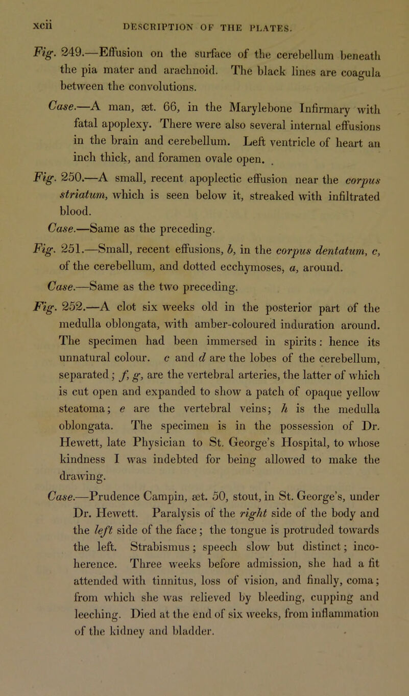 Fig. 249.—Effusion on the surface of the cerebellum beneath the pia mater and arachnoid. The black lines are coagula between the convolutions. Case.—A man, set. 66, in the Marylebone Infirmary with fatal apoplexy. There were also several internal effusions in the brain and cerebellum. Left ventricle of heart an inch thick, and foramen ovale open. Fig. 250.—A small, recent apoplectic effusion near the corpus striatum, which is seen below it, streaked with infiltrated blood. Case.—Same as the preceding. Fig. 251.—Small, recent effusions, b, in the corpus dentatum, c, of the cerebellum, and dotted ecchymoses, a, around. Case.—Same as the two preceding. Fig. 252.—A clot six weeks old in the posterior part of the medulla oblongata, with amber-coloured induration around. The specimen had been immersed in spirits: hence its unnatural colour, c and d are the lobes of the cerebellum, separated; f g, are the vertebral arteries, the latter of which is cut open and expanded to show a patch of opaque yellow steatoma; e are the vertebral veins; h is the medulla oblongata. The specimen is in the possession of Dr. Hewett, late Physician to St. George’s Hospital, to whose kindness I was indebted for being allowed to make the drawing. Case.—Prudence Campin, set. 50, stout, in St. George’s, under Dr. Hewett. Paralysis of the right side of the body and the left side of the face; the tongue is protruded towards the left. Strabismus; speech slow but distinct; inco- herence. Three weeks before admission, she had a fit attended with tinnitus, loss of vision, and finally, coma; from which she was relieved by bleeding, cupping and leeching. Died at the end of six weeks, from inflammation of the kidney and bladder.