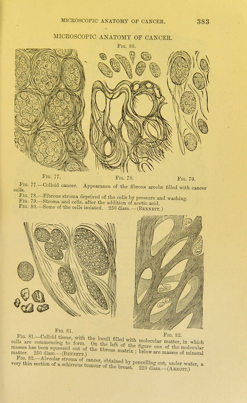 MICROSCOPIC ANATOMY OF CANCER. Fig. 80. Fig. 77 Fig. 78. Fig. 79. ceUs^'^' Appearance of the fibrous areola filled with cancer ^Jf' lo^?'' stroma deprived of the ceUs by pressure and washing, -tf IG. 79.—btroma and ceUs, after the addition of acetic acid J?iG. 80.—Some of the cells isolated. 250 diam.—(Bennett ) Fio. 81. Fig. 81.—Colloid tis.sue, with the loculi fillp,! .vUi, i , cells are commencing to'form. On the left of f i^ftter, in which masses has been squeezed out of the fibrous miriJ °^ 'lecular matter. 250 diam.-(BENNETT.) ^' ^^^ ^^^^^^ of mineral Fig. 82.—Alveolar stroma of cancpr n1ifo;«„)i