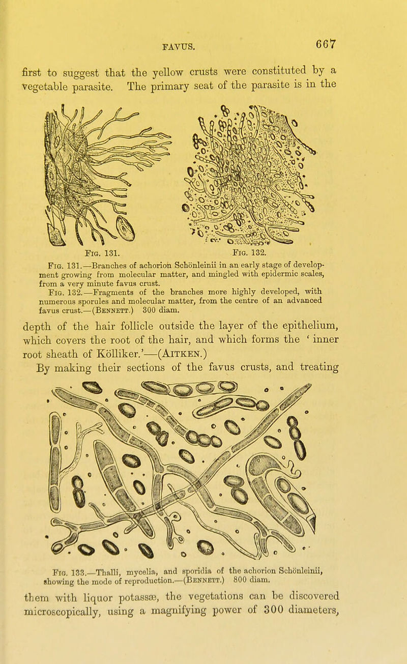 FAVUS. first to suggest thcat the yellow crusts were constituted by a vegetable parasite. The primary seat of the parasite is in the Fig. 131. Fig. 132. Fig. 131.—Branches of achorion Scbonleinii in an early stage of develop- ment growing from molecular matter, and mingled with epidermic scales, from a very minute favus crust. Fig. 132.—Fragments of the branches more highly developed, with numerous sporules and molecular matter, from the centre of an advanced favus crust.—(Bennett.) 300 diam. depth of the hair follicle outside the layer of the epithelium, which covers the root of the hair, and which forms the ' inner root sheath of Kolliker.'—(Aitken.) By making their sections of the favus crusts, and treating Fig. 133. Thalli, mycelia, and sporidia of the achorion Schonleinii, showing the mode of reproduction.—(Bennett.) 800 diam. them with liquor potassse, the vegetations can be discovered microscopically, using a magnifying power of 300 diameters.