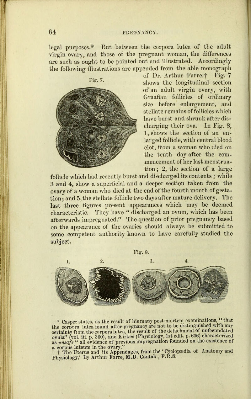 legal purposes.* But between the corpora lutea of the adult virgin ovary, and those of the pregnant woman, the differences are such as ought to be pointed out and illustrated. Accordingly the following illustrations are appended from the able monograph of Dr. Arthur Farre.f Fig. 7 Fi2r< 7‘ shows the longitudinal section of an adult virgin ovary, with Graafian follicles of ordinary size before enlargement, and stellate remains of follicles which have burst and shrunk after dis- charging their ova. In Fig. 8, 1, shows the section of an en- larged follicle, with central blood clot, from a woman who died on the tenth day after the com- mencement of her last menstrua- tion ; 2, the section of a large follicle which had recently burst and discharged its contents ; while 8 and 4, show a superficial and a deeper section taken from the ovary of a woman who died at the end of the fourth month of gesta- tion; and 5, the stellate follicle two days after mature delivery. The last three figures present appearances which may be deemed characteristic. They have “ discharged an ovum, which has been afterwards impregnated.” The question of prior pregnancy based on the appearance of the ovaries should always be submitted to some competent authority known to have carefully studied the subject. Fig. 8. * Casper states, as the result of liis many post-mortem examinations, ‘‘ that the corpora lutea found after pregnancy are not to be distinguished with any certainty from the corpora lutea, the result of the detachment of unfecundated ovula” (vol. iii. p. 360), and Kirkes (Physiology, 1st edit, p.606) characterized as unsafe “ all evidence of previous impregnation founded on the existence of a corpus luteum in the ovary.” , , t The Uterus and its Appendages, from the ‘ Cyclopaedia of Anatomy and Physiology.’ By Arthur Farre, M.D. Cantab., F.R.S.
