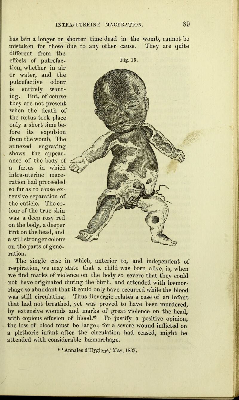 has lain a longer or shorter time dead in the womb, cannot be mistaken for those due to any other cause. They are quite different from the effects of putrefac- Fig. 15. tion, whether in air or water, and the putrefactive odour is entirely want- ing. But, of course they are not present when the death of the foetus took place only a short time be- fore its expulsion from the womb. The annexed engraving shows the appear- ance of the body of a foetus in which intra-uterine mace- ration had proceeded so far as to cause ex- tensive separation of the cuticle. The co- lour of the true skin was a deep rosy red on the body, a deeper tint on the head, and a still stronger colour on the parts of gene- ration. The single case in which, anterior to, and independent of respiration, we may state that a child was born alive, is, when we find marks of violence on the body so severe that they could not have originated during the birth, and attended with iiaemor- rhage so abundant that it could only have occurred while the blood was still circulating. Thus Devergie relates a case of an infant that had not breathed, yet was proved to have been murdered, by extensive wounds and marks of great violence on the head, with copious effusion of blood.* To .justify a positive opinion, the loss of blood must be large; for a severe wound inflicted on a plethoric infant after the circulation had ceased, might be attended with considerable haemorrhage. * ‘Annales d’Hygiene,’ May, 1837.
