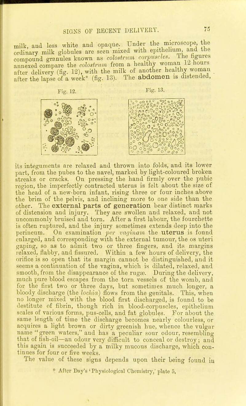 SIGNS OF RECENT DELIVERY. milk, and less white and opaque. Under the microscope, the ordinary milk globules are se'eu mixed with epithelium, and the compound granules known as colostrum corpuscles. Ihe fagures annexed compare the colostrum from a healthy woman 12 hours after delivery (fig. 12), with the milk of another healthy woman after the lapse of a week* (fig. 13). The abdomen is distended, Fig. 12. Fig. 13. its integuments ai-e relaxed and thrown into folds, and its lower part, fi-om the pubes to the navel, marked by light-coloured broken streaks or cracks. On pressing the hand firmly over the pubic region, the imperfectly contracted uterus is felt about the size of the head of a new-born infant, rising three or four inches above the brim of the pelvis, and inclining more to one side than the other. The external parts of generation bear distinct marks of distension and injury. They are swollen and relaxed, and not uncommonly bruised and torn. After a first labour, the fourchette is often ruptured, and the injury sometimes extends deep into the perineum. On examination per vaginam the uterus is found enlarged, and corresponding with the external tumour, the os uteri gaping, so as to admit two or three fingers, and its margins i-elaxed, flabby, and fissured. Within a few hours of delivery, the orifice is so open that its margin cannot be distinguished, and it seems a continuation of the vagina, which is dilated, relaxed, and smooth, from the disappearance of the rugae. Daring the delivery, much pure blood escapes from the torn vessels of the womb, and for the first two or three days, but sometimes much longer, a bloody discharge (the lochia) flows from the genitals. This, when no longer mixed with the blood first discharged, is found to be destitute of fibrin, though rich in blood-corpuscles, epithelium scales of various forms, pus-cells, and fat globules. For about the same length of time the discharge becomes nearly colourless, or acquires a light brown or dirty greenish hue, whence the vulgar name green waters, and has a peculiar sour odour, resembling that of fish-oil—an odour very difficult to conceal or destroy; and this again is succeeded by a milky mucous discharge, which con- tinues for four or five weeks. The value of these signs depends upon their being found in «' After Day's ' Physiological Chemiatry,' plate 5,