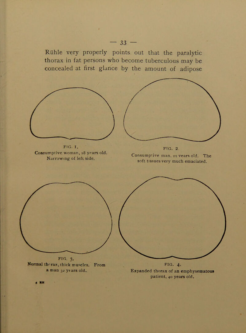 Ruble very properly points out that the paralytic thorax in fat persons who become tuberculous may be concealed at first glance by the amount of adipose FIG. I. CoBSUirptive woman, ypars old. Narrowing of left side. FIG. 2. Consumptive man. 2q years old. The soft tissues very much emaciated. Normal thi rax, thick muscles. From a man 32 years old. Expanded thorax of an emphysematous patient, 40 years old. 4 an