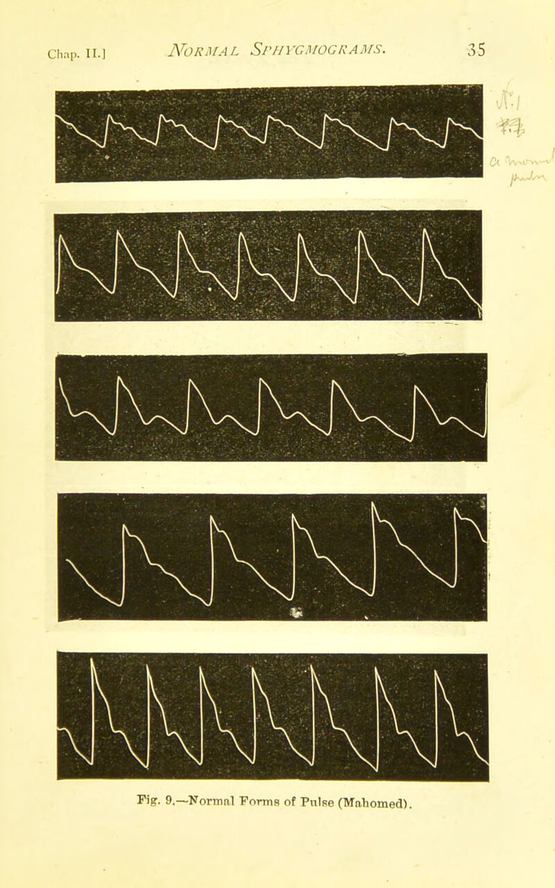 Chap. IT.] NoR^fAL Sphvcmograms. 2>$ Fig. 9.—Normal Forms of Pnlse (Mahomed).