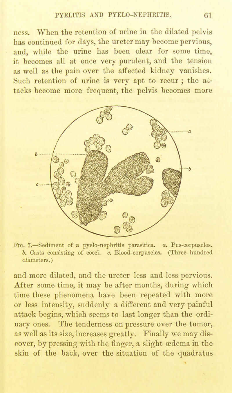 ness. When the retention of urine in the dilated pelvis has continued for days, the ureter may become pervious, and, while the urine has been clear for some time, it becomes all at once very purulent, and the tension as well as the pain over the affected kidney vanishes. Such retention of urine is very apt to recur ; the at- tacks become more frequent, the pelvis becomes more Fig. 7.—Sediment of a pyelo-nephritis parasitica, a. Pus-coi-puscles. h. Casts consisting of cocci, c. Blood-corpuscles, (Three hundred diameters.) and more dilated, and the ureter less and less pervious. After some time, it may be after months, during which time these phenomena have been repeated with more or less intensity, suddenly a different and very painful attack begins, which seems to last longer than the ordi- nary ones. The tenderness on pressure over the tumor, as well as its size, increases greatly. Finally we may dis- cover, by pressing with the finger, a slight oedema in the skin of the back, over the situation of the quadratus