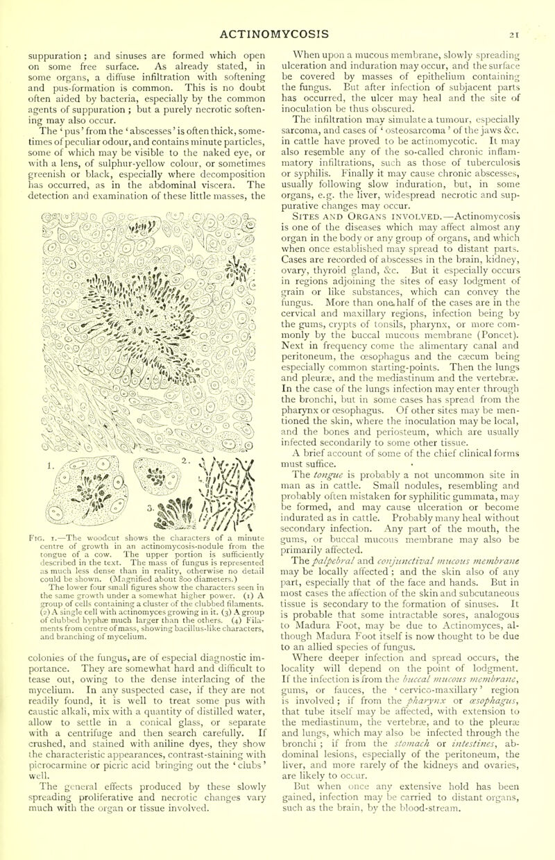 suppuration ; and sinuses are formed which open on some free surface. As already stated, in some organs, a diffuse infiltration with softening and pus-formation is common. This is no doubt often aided by bacteria, especially by the common agents of suppuration ; but a purely necrotic soften- ing may also occur. The ' pus' from the ' abscesses' is often thick, some- times of peculiar odour, and contains minute particles, some of which may be visible to the naked eye, or with a lens, of sulphur-yellow colour, or sometimes greenish or black, especially where decomposition has occurred, as in the abdominal viscera. The detection and examination of these little masses, the r'iG. I.—The woodcut shows the characters of a minute centre of growth m an actinomycosis-nodule from the tongue of a cow. The upper portion is sufficiently described in the text. The mass of fungus is represented as mucli less dense than in reality, otherwise no detail could be shown. (Magnified about 800 diameters.) The lower four small figures show the characters seen in the same growth under a somewhat higher power, (i) A group of cells containing a cluster of the clubbed filaments. (2) A single cell with actinomyces growing in it. (3) .\ group of clubbed hyphas much larger than the others. (4) Fila- ments from centre of mass, showing bacillus-like characters, and branching of mycelium. colonies of the fungus, are of especial diagnostic im- portance. They are somewhat hard and difficult to tease out, owing to the dense interlacing of the mycelium. In any suspected case, if they are not readily found, it is well to treat some pus with caustic alkali, mix with a quantity of distilled water, allow to settle in a conical glass, or separate with a centrifuge and then search carefully. If crushed, and stained with aniline dyes, they show the characteristic appearances, contrast-staining with picrocarmine or picric acid bringing out the ' clubs' well. The guuL-ral effects produced by these slowly spreading proliferative and necrotic changes vary much with the organ or tissue involved. When upon a mucous membrane, slowly spreading ulceration and induration may occur, and the surface be covered by masses of epithelium containing the fungus. But after infection of subjacent parts has occurred, the ulcer may heal and the site of inoculation be thus obscured. The infiltration may simulate a tumour, especially sarcoma, and cases of ' osteosarcoma' of the jaws &c. in cattle have proved to be actinomycotic. It may also resemble any of the so-called chronic inflam- matory infiltrations, such as those of tuberculosis or syphilis. Finally it may cause chronic abscesses, usually following slow induration, but, in some organs, e.g. the liver, widespread necrotic and sup- purative changes may occur. Sites an'D Organs involved.—Actinomycosis is one of the diseases which may affect almost any organ in the body or any group of organs, and which when once established may spread to distant parts. Cases are recorded of abscesses in the brain, kidney, ovary, thyroid gland, cS:c. But it especially occurs in regions adjoining the sites of easy lodgment of grain or like substances, which can convey the fungus. More than one.half of the cases are in the cervical and maxillary regions, infection being by the gums, crypts of tonsils, pharynx, or more com- monly by the buccal mucous membrane (Poncet). Next in frequency come the alimentary canal and peritoneum, the oesophagus and the crecum being especially common starting-points. Then the lungs and pleurse, and the mediastinum and the vertebrae. In the case of the lungs infection may enter through the bronchi, but in some cases has spread from the pharynx or oesophagus. Of other sites may be rnen- tioned the skin, where the inoculation may be local, and the bones and periosteum, which are usually infected secondarily to some other tissue. A brief account of some of the chief clinical forms must suffice. The to)igue is probably a not uncommon site in man as in cattle. Small nodules, resembling and probably often mistaken for syphilitic gummata, may be formed, and may cause ulceration or become indurated as in cattle. Probably many heal without secondary infection. Any part of the mouth, the gums, or buccal mucous membrane may also be primarily affected. The palpebral and coujttnctival iniicoiis membrane may be locally affected ; and the skin also of any part, especially that of the face and hands. But in most cases the affection of the skin and subcutaneous tissue is secondary to the formation of sinuses. It is probable that some intractable sores, analogous to Madura Foot, may be due to Actinomyces, al- though Madura Foot itself is now thought to be due to an allied species of fungus. Where deeper infection and spread occurs, the locality will depend on the point of lodgment. If the infection is from the buccal mucous membrane, gums, or fauces, the ' cervico-maxillary' region is involved ; if from the pharynx or oesophagus, that tube itself may be affected, with extension to the mediastinum, the vertebrce, and to the pleura: and lungs, which may also be infected through the bronchi ; if from the stomach or intestines, ab- dominal lesions, especially of the peritoneum, the liver, and more rarely of the kidneys and ovaries, are likely to occur. But when once any extensive hold has been gained, infection may be carried to distant organs, such as the brain, by the lilood-stream.