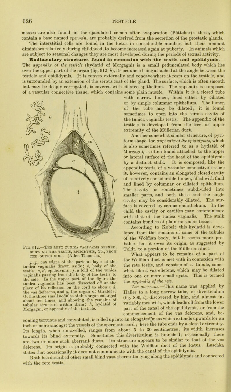 masses are also found in the ejaculated semen after evaporation (Bottcher) : these, which contain a base named spermin, are probably derived from the seeretion of the prostatic glands. The interstitial cells are found in the foetus in considerable number, but their amount diminishes relatively during childhood, to become inereased again at puberty. In animals whieh are subject to seasonal ehanges they are most developed during the periods of sexual activity. Rudimentary structures found in connexion with the testis and epididymis.— The appendix of the testicle (hydatid of Morgagni) is a small pedunculated body which lies over the upper part of the organ (fig. 912, h), its peduncle being attached at the angle between the testicle and epididymis. It is convex externally and concave where it rests on the testicle, and is surrounded by an extension of the serous coat of the gland. The surface, whieh is often smooth but may be deeply corrugated, is covered with ciliated epithehum. The appendix is composed of avascular connective tissue, which contains some plain muscle. Within it is a closed tube with narrow lumen, lined either by ciliated or by simple columnar epithelium. The lumen of the tube may be dilated; it is found sometimes to open into the serous cavity of the tunica vaginahs testis. The appendix of the testicle is developed from the free or upper extremity of the Miillerian duct. Another somewhat similar strueture, of pyri- form shape, the appendix of the epididymis, which is also sometimes referred to as a hydatid of Morgagni, is often found attached to the upper or lateral surface of the head of the epididymis by a distinet stalk. It is composed, like the appendix testis, of a vaseular eonnective tissue ; it, however, contains an elongated closed cavity of relatively considerable lumen, fiUed with fluid and lined by eolumnar or cfliated epithelium. The cavity is sometimes subdivided into smaller parts, and both these and the single cavity may be eonsiderably dilated. The sur- face is covered by serous endothehum. In the child the. cavity or cavities may communicate with that of the tunica vaginahs. The stalk contains bundles of plain muscular tissue. According to Kobelt this hydatid is deve- loped from the remains of some of the tubules of the Wolffian body, but it seems more pro- bable that it owes its origin, as suggested by Toldt, to a portion of the Mullerian duct. What appears to be remains of a part of the Wolffian duct is met with in connexion with the rete testis, and consists of a tubule, some- what like a vas efferens, whieh may be dilated into one or more small cysts. This is termed the appendix of the rete. Vas aberrans.—This name was apphed by Haller to a long narrow tube, or divertieulum (fig. 890, i), discovered by liim, and almost in- variably met with, whieh leads off from the lower part of the canal of the epididymis, or from the commencement of the vas deferens, and, be- coming tortuous and eonvoluted, is rolled up into an elongated'mass which extends upwards for an ineh or more amongst the vessels of the spermatic cord ; here the tube ends by a closed extremity. Its length, when unravelled, ranges from about 5 to 30 centimetres ; its width incieases towards its blind extremity. Sometimes this diverticulum is branched; occasionally there are two or more such aberrant ducts. Its structure appears to bo similar to that of the vas deferens. Its origin is probably oonneeted with the Wolffian duct of the foetus. Luschka states that occasionally it does not communicate with the canal of the epididymis. Roth has described other small blind vasa aberrantia lying along the epididymis and connected with the rete testis. Pig. 912.—The left tunica vaginalis opened, SHOWING THE TESTIS, EPIDIDYMIS, &C., FROM THE OUTER SIDE. (Allen Tliomson.) p,2J, cut edges of the parietal layer of the tunica vaginalis drawn aside; t, body of the testis; e, e', epididymis; /, a fold of the tunica vaginalis passing from the body of the testis to the side. In the upper part of the figure the tunica vaginalis has been dissected off at the place of its reflexion on. the cord to show v d, the vas deferens, and g, the organ of Giraldes; Or, the three small nodules of this organ enlarged about ten times, and showing the remains of tubular structure within them; li, hydatid of Morgagni, or aiipendix of the testicle.